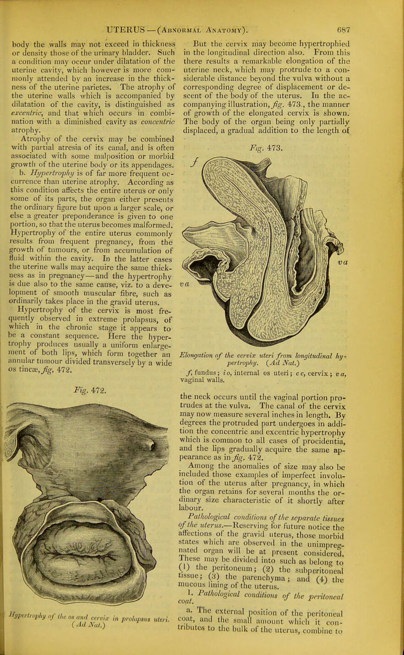 body the walls may not exceed in thickness or density those of the urinary bladder. Such a condition may occur under dilatation of the uterine cavity, wiiich however is more com- monly attended by an increase in the thick- ness of the uterine parietes. The atrophy of the uterine walls which is accompanied by dilatation of the cavity, is distinguished as excenlric, and that which occurs in combi- nation with a diminished cavity as concentric atrophy. Atrophy of the cervix may be combined with partial atresia of its canal, and is often associated with some malposition or morbid growth of the uterine body or its appendages. b. Hi/j)ertro2}hi/ is of far more frequent oc- currence than uterine atrophy. According as this condition affects the entire uterus or only some of its parts, the organ either presents the ordinary figure but upon a larger scale, or else a greater preponderance is given to one portion, so that the uterus becomes malformed. Hypertrophy of the entire uterus commonly results from frequent pregnancy, from the growth of tumours, or from accumulation of fluid within the cavity. In the latter cases the uterine walls may acquire the same thick- ness as in pregnancy — and the hypertrophy is due also to the same cause, viz. to a deve- lopment of smooth muscular fibre, such as ordinarily takes place in the gravid uterus. Hypertrophy of the cervix is most fre- quently observed in extreme prolapsus, of which in the chronic stage it appears to be a constant sequence. Here the hyper- trophy produces usually a uniform enlarge- ment of both lips, which form together an annular tumour divided transversely by a wide OS tincaE,/g. 472. Fig. 472. lJypeHr„phy of the on and cervix in prolapsus uteri. (Ad Nal.) But the cervix may become hj'pertrophied in the longitudinal direction also. From this there results a remarkable elongation of the uterine neck, which may protrude to a con- siderable distance beyond the vulva without a corresponding degree of displacement or de- scent of the body of the uterus. In the ac- companying illustration,473., the manner of growth of the elongated cervix is shown. The body of the organ being only partially displaced, a gradual addition to the length of Fig. 473. Elongation of the cervix uteri from longittidinal hy- pertrophy. (^Ad Nat.) f, fundus; io, internal os uterij cc, cervix j va, vaginal walls. the neck occurs until the vaginal portion pro- trudes at the vulva. The canal of the cervix may now measure several inches in length. By degrees the protruded part undergoes in addi- tion the concentric and excentric hypertrophy which is common to all cases of procidentia, and the lips gradually acquire the same ap- pearance as in Jig. 472. Among the anomalies of size may also be included those examples of imperfect involu- tion of the uterus after pregnancy, in which the organ retains for several months the or- dinary size characteristic of it shortly after labour. Pathological conditions of the separate tissues of the uterus.—Reserving for future notice the affections of the gravid uterus, those morbid states which are observed in the unimpre<r- nated organ will be at present considered. 1 hese may be divided into such as belon<r to (1) the peritoneum; (2) the subperitoneal tissue; the parenchyma; and (4) the mucous linmg of the uterus. coat ^'^'o'''^ conditions of the jjcriloueal a. Tiic external position of the peritoneal coat, and the small amount which it con- tributes to the bulk of the uterus, combine to