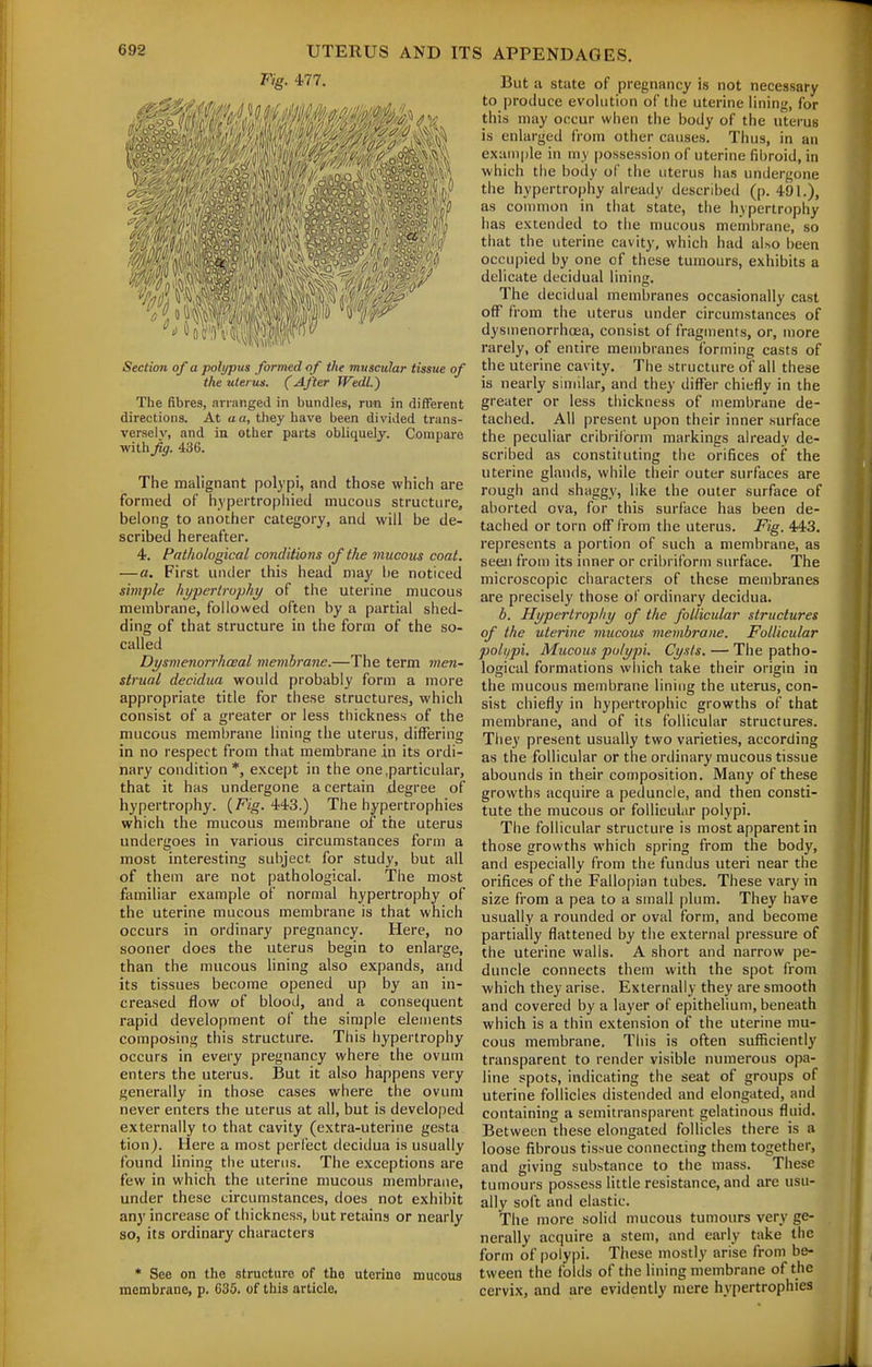 Fig. 477. Section of a polyptis formed o f the muscular tissue of the uterus. (After Wedl.) The fibres, arranged in bundles, run in different directions. At a a, they have been divided truns- verselv, and in other parts obliquely. Compare with fg. 436. The malignant polypi, and those which are formed of hypertrophied mucous structure, belong to another category, and will be de- scribed hereafter. 4. Pathological conditions of the mucous coat. — a. First under this head may be noticed simple hypertrophy of the uterine mucous membrane, followed often by a partial shed- ding of that structure in the form of the so- called Di/smenorrhceal membrane.—The term men- strual dectdua would probably form a more appropriate title for these structures, which consist of a greater or less thickness of the mucous membrane lining the uterus, differing in no respect from that membrane in its ordi- nary condition *, except in the one .particular, that it has undergone a certain degree of hypertrophy. (7^;^. 443.) The hypertrophies which the mucous membrane of the uterus undergoes in various circumstances form a most interesting subject for study, but all of them are not pathological. The most familiar example of normal hypertrophy of the uterine mucous membrane is that which occurs in ordinary pregnancy. Here, no sooner does the uterus begin to enlarge, than the mucous hning also expands, and its tissues become opened up by an in- creased flow of blood, and a consequent rapid development of the simple elements composing this structure. This hypertrophy occurs in every pregnancy where the ovum enters the uterus. But it also happens very generally in those cases where the ovum never enters the uterus at all, but is developed externally to that cavity (extra-uterine gesta tion). Here a most perfect decidua is usually found lining tlie uterus. The exceptions are few in which the uterine mucous membrane, under these circumstances, does not exhibit any increase of thickness, but retains or nearly so, its ordinary characters * See on the structure of the uterine mucous membrane, p. 636. of this article. But a state of pregnancy is not necessary to produce evolution of the uterine lining, for this may occur when the body of the uterus is enlarged from other causes. Thus, in an example in my possession of uterine fibroid, in which the body of the uterus has undergone the hypertrophy already described (p. 491.), as common in that state, the hypertrophy has extended to the mucous membrane, so that the uterine cavity, which had al.so been occupied by one of these tumours, exhibits a delicate decidual lining. The decidual membranes occasionally cast off from the uterus under circumstances of dysinenorrhcea, consist of fragments, or, more rarely, of entire membranes forming casts of the uterine cavity. The structure of all these is nearly similar, and they differ chiefly in the greater or less thickness of membrane de- tached. All present upon their inner surface the peculiar cribriform markings already de- scribed as constituting the orifices of the uterine glands, while their outer surfaces are rough and shaggy, like the outer surface of aborted ova, for this surface has been de- tached or torn off from the uterus. Fig. 443. represents a portion of such a membrane, as seen fi'om its inner or cribriform surface. The microscopic characters of these membranes are precisely those of ordinary decidua. b. Hypertrophy of the follicular structures of the uterine mucous membrane. Follicular poll/pi. Mucous polypi. Cysts. — The patho- logical formations wliich take their origin in the mucous membrane lining the uterus, con- sist chiefly in hypertrophic growths of that membrane, and of its follicular structures. They present usually two varieties, according as the follicular or the ordinary mucous tissue abounds in their composition. Many of these growths acquire a peduncle, and then consti- tute the mucous or follicular polypi. The follicular structure is most apparent in those growths which spring from the body, and especially from the fundus uteri near the orifices of the Fallopian tubes. These vary in size from a pea to a small plum. They have usually a rounded or oval form, and become partially flattened by tiie external pressure of the uterine walls. A short and narrow pe- duncle connects them with the spot from which they arise. Externally they are smooth and covered by a layer of epithelium, beneath which is a thin extension of the uterine mu- cous membrane. This is often sufficiently transparent to render visible numerous opa- line spots, indicating the seat of groups of uterine follicles distended and elongated, and containing a semitransparent gelatinous fluid. Between these elongated follicles there is a loose fibrous tissue connecting them together, and giving substance to the mass. These tumours possess little resistance, and are usu- ally soft and elastic. The more solid mucous tumours very ge- nerally acquire a stem, and early take the form of polypi. These mostly arise from be- tween the folds of the lining membrane of the cervix, and are evidently mere hypertrophies