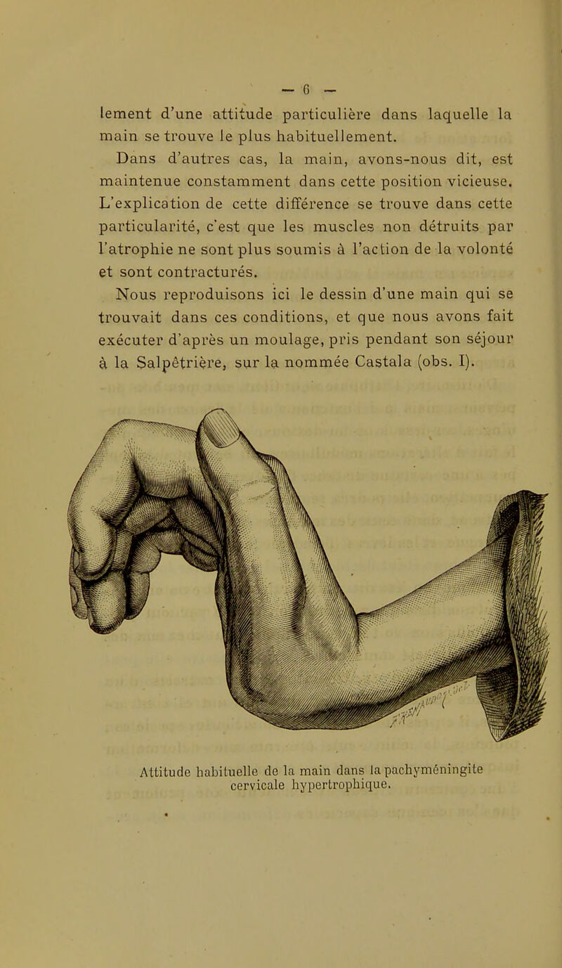 s lement d’une attitude particulière dans laquelle la main se trouve le plus habituellement. Dans d’autres cas, la main, avons-nous dit, est maintenue constamment dans cette position vicieuse. L’explication de cette différence se trouve dans cette particularité, c'est que les muscles non détruits par l’atrophie ne sont plus soumis à l’action de la volonté et sont contracturés. Nous reproduisons ici le dessin d’une main qui se trouvait dans ces conditions, et que nous avons fait exécuter d’après un moulage, pris pendant son séjour à la Salpêtrière, sur la nommée Castala (obs. I). Attitude habituelle de la main dans la pachyméningite cervicale hypertrophique.