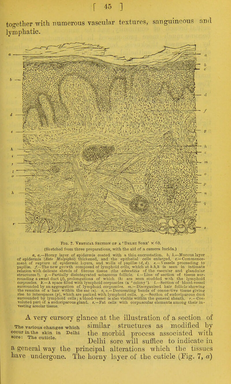 too-ether with numerous vascular textures, sanguineous and lymphatic. Fio. 7. Vbetioai. Section op a ' Delhi Sorb' x f 0. (Sketched from three preparations, with the aid of a camera lucida.) a, a.—Horny layer of epidermis coated with a thio eucrustation. 6, h.—Mucous layer of epidermis (Rete Malpighii) thickened, and the epithelial cells enlarged, c—Commence- ment of rupture of epidermic layers, and wnlls of papillae (rf, rf). «.—Vessels proceeding to papillae. /.—The new growth composed of lymphoid cpUs, which at h h,li is seen in intimate relation with delicate shreds of fibrous tissue (the adveiititia nf the vascular and glandular structures?). —Partially disintegrated sebaceous follicle, t. —Line of section of tissue sur- roundine a sweat duct U), prolongations of which (ft) ai'e seen studded with the lymphoid corpuscles, ifc.—A space tilled with lymphoid corpuscles (a 'colony'), i.—Section of blood-vessel surrounded by an aggregation of lymphoid corpuscles, m.—Disorganised hair foliiole showing the remains of a' hair within the sac in), o, o.—Decussating bunds of connective tissue giving rise to interspaces (p), which are packed with lymphoid cells, q.—Section of sudoriparous duct surrounded by lymphoid cells; a blood-vessel is also visible within the general sheath. Con- voluted part of a sudoriparous gland. Fat cells with corpuscular elements among their in- Testing areolar tissue. A very cursory glance at the illustration of a section of The various changes which simikr structures as modified by Bor^^ife^ skin in Delhi tlic morbid procGss associatcd with ^ °^ '° ^' Delhi sore will suffice to indicate in a general way the principal alterations which the tissues have undergone. The horny layer of the cuticle (Eig. 7, a)