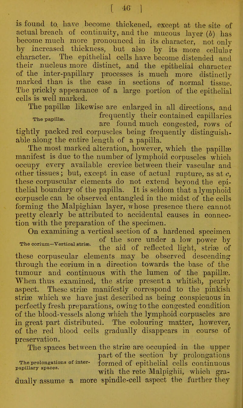 [ 1 is found to. liave become thickened, except at the site of actual breach of continuity, and the mucous layer (b) has become much more pronounced in its character, not only by increased thickness, but also by its more cellular character. The epithelial cells have become distended and their nucleus more distinct, and the epithelial character of the inter-papillary processes is much more distinctly marked than is the case in sections of normal tissue. The prickly appearance of a large portion of the epithelial cells is well marked. The papillte likewise are enlarged in all directions, and The papiuee. frequently their contained capillaries are found much congested, rows of tightly packed red corpuscles being frequently distinguish- able along the entire length of a papilla. The most marked alteration, however, which the papillae manifest is due to the number of lymphoid corpuscles which occupy every available crevice between their vascular and other tissues; but, except in case of actual rupture, as at c, these corpuscular elements do not extend beyond the epi- thelial boundary of the papilla. It is seldom that a lymphoid corpuscle can be observed entangled in the midst of the cells forming the Malpighian layer, whose presence there cannot pretty clearly be attributed to accidental causes in connec- tion with the preparation of the specimen. On examining a vertical section of a hardened specimen ^ „ of the sore under a low power by Tne coritun—V ertical striee. jitij i- p the aid oi renected light, striae of these corpuscular elements may be observed descending through the corium in a direction towards the base of the tumour and continuous with the lumen of the papillae. When thus examined, the striae present a whitish, pearly aspect. These striae manifestly correspond to the pinkish striae which we have just described as being conspicuous in perfectly fresh preparations, owing to the congested condition of the blood-vessels along which the lymphoid corpuscles are in great part distributed. The colouring matter, however, of the red blood cells gradually disappears in course of preservation. The spaces between the striae are occupied in the upper part of the section by prolongations The prolongations of inter- formed of epithelial cells continuous papillary spaces. with the Tctc Malpighii, which gra- dually assume a more spindle-cell aspect tlie further they