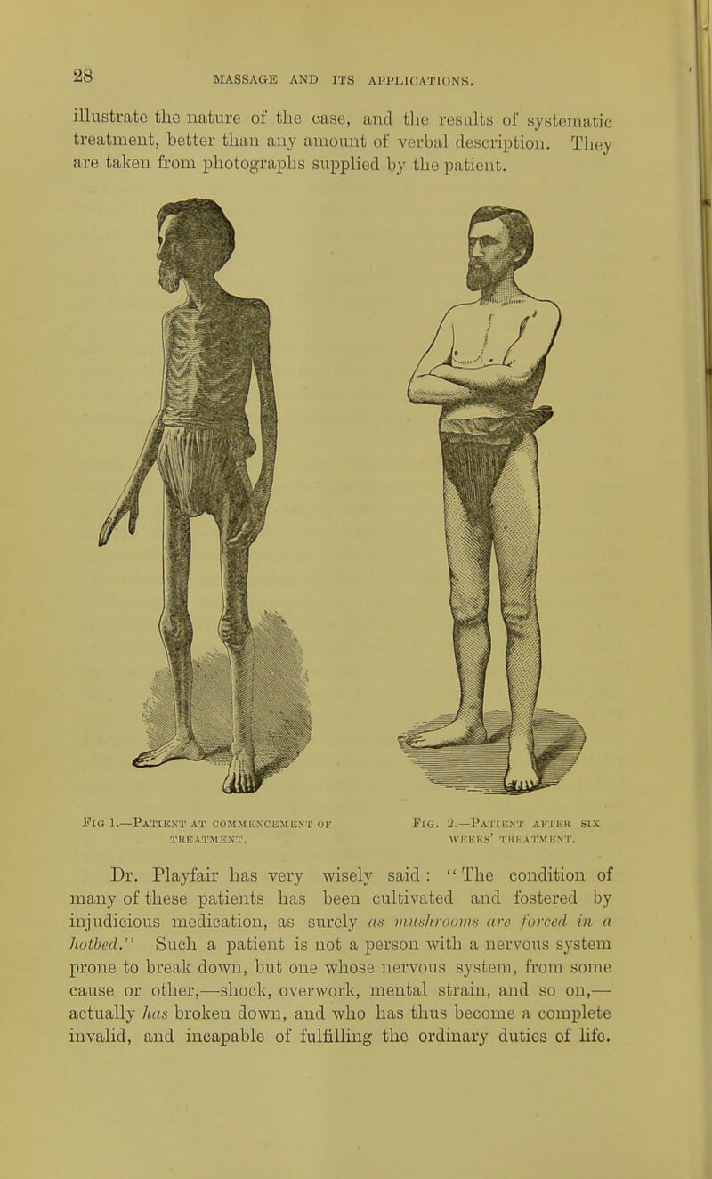 illustrate the nature of the oase, and tlie results of systematic treatment, better than any amount of verbal description. They are taken from photographs supplied by the patient. J?iG 1.—Patient AT coMMEXCEME.NT oi' Pig. l'.—Patient ai-ter six TKEATMENT. WEEKS' TREATMENT. Dr. Playfair has very wisely said:  The condition of many of these patients has been cultivated and fostered by injudicious medication, as surely as vmahrfloinn are farced in a hutbed. Such a patient is uot a person with a nervous system prone to break down, but one whose nervous system, from some cause or other,—shock, overwork, mental strain, and so on,— actually lias broken down, and who has thus become a complete invalid, and incapable of fulfilling the ordinary duties of hfe.