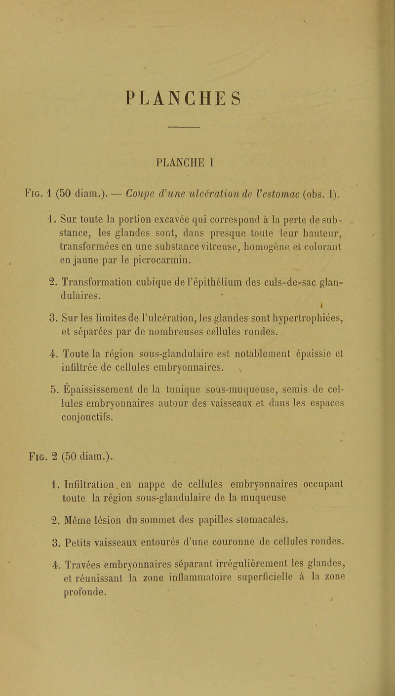 PLANCHES PLANCHE I FiG. 1 (50 diam.).— Coupe d'une ulcération de Vestomac (obs. I). 1. Sue toute la portion excavée qui correspond à la perte de sub- stance, les glandes sont, dans presque toute leur hauteur, transformées en une substance vitreuse, homogène et colorant en jaune par le picrocarmin. 2. Transformation cubique de l'épithélium des culs-de-sac glan- dulaires. 3. Sur les limites de l'ulcération, les glandes sont hypertrophiées, et séparées par de nombreuses cellules rondes. 4. Toute la région sous-glandulaire est notablement épaissie et infiltrée de cellules embryonnaires. ^ 5. Épaississement de la tunique sous-muqueuse, semis de cel- lules embryonnaires autour des vaisseaux et dans les espaces conjonctifs. FiG. 2 (50 diam.). 1. Infiltration en nappe de cellules embryonnaires occupant toute la région sous-glandulaire de la muqueuse 2. Même lésion du sommet des papilles stomacales. 3. Petits vaisseaux entourés d'une couronne de cellules rondes. 4. Travées embryonnaires séparant irrégulièrement les glandes, et réunissant la zone inflammatoire superficielle à la zone profonde.
