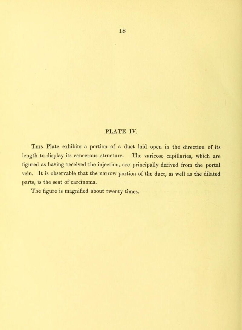 PLATE IV. This Plate exhibits a portion of a duct laid open in the direction of its length to display its cancerous structure. The varicose capillaries, which are figured as having received the injection, are principally derived from the portal vein. It is observable that the narrow portion of the duct, as well as the dilated parts, is the seat of carcinoma. The figure is magnified about twenty times.