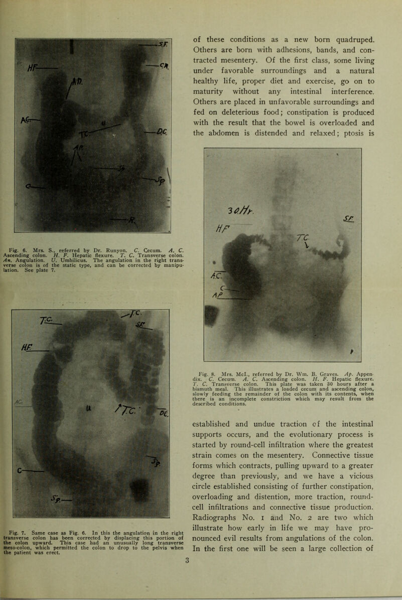 Fig. 6. Mrs. S., referred by Dr. Runyon. C. Cecum. A. C. Ascending colon. H. F. Hepatic flexure. T. C. Transverse colon. An. Angulation. U. Umbilicus. The angulation in the right trans- verse colon is of the static type, and can be corrected by manipu- lation. See plate 7. Fig. 7. Same case as Fig. 6. In this the angulation in the right transverse colon has been corrected by displacing this portion of the colon upward. This case had an unusually long transverse meso-colon, which permitted the colon to drop to the pelvis when the patient was erect. of these conditions as a new born quadruped. Others are born with adhesions, bands, and con- tracted mesentery. Of the first class, some living under favorable surroundings and a natural healthy life, proper diet and exercise, go on to maturity without any intestinal interference. Others are placed in unfavorable surroundings and fed on deleterious food; constipation is produced with the result that the bowel is overloaded and the abdomen is distended and relaxed; ptosis is Hr t Fig. 8. Mrs. Mcl., referred by Dr. Wm. B. Graves. Ap. Appen- dix. C. Cecum. A. C. Ascending colon. H. F. Hepatic flexure. T. C. Transverse colon. This plate was taken 30 hours after a bismuth meal. This illustrates a loaded cecum and ascending colon, slowly feeding the remainder of the colon with its contents, when there is an incomplete constriction which may result from the described conditions. established and undue traction of the intestinal supports occurs, and the evolutionary process is started by round-cell infiltration where the greatest strain comes on the mesentery. Connective tissue forms which contracts, pulling upward to a greater degree than previously, and we have a vicious circle established consisting of further constipation, overloading and distention, more traction, round- cell infiltrations and connective tissue production. Radiographs No. i and No. 2 are two which illustrate how early in life we may have pro- nounced evil results from angulations of the colon. In the first one will be seen a large collection of