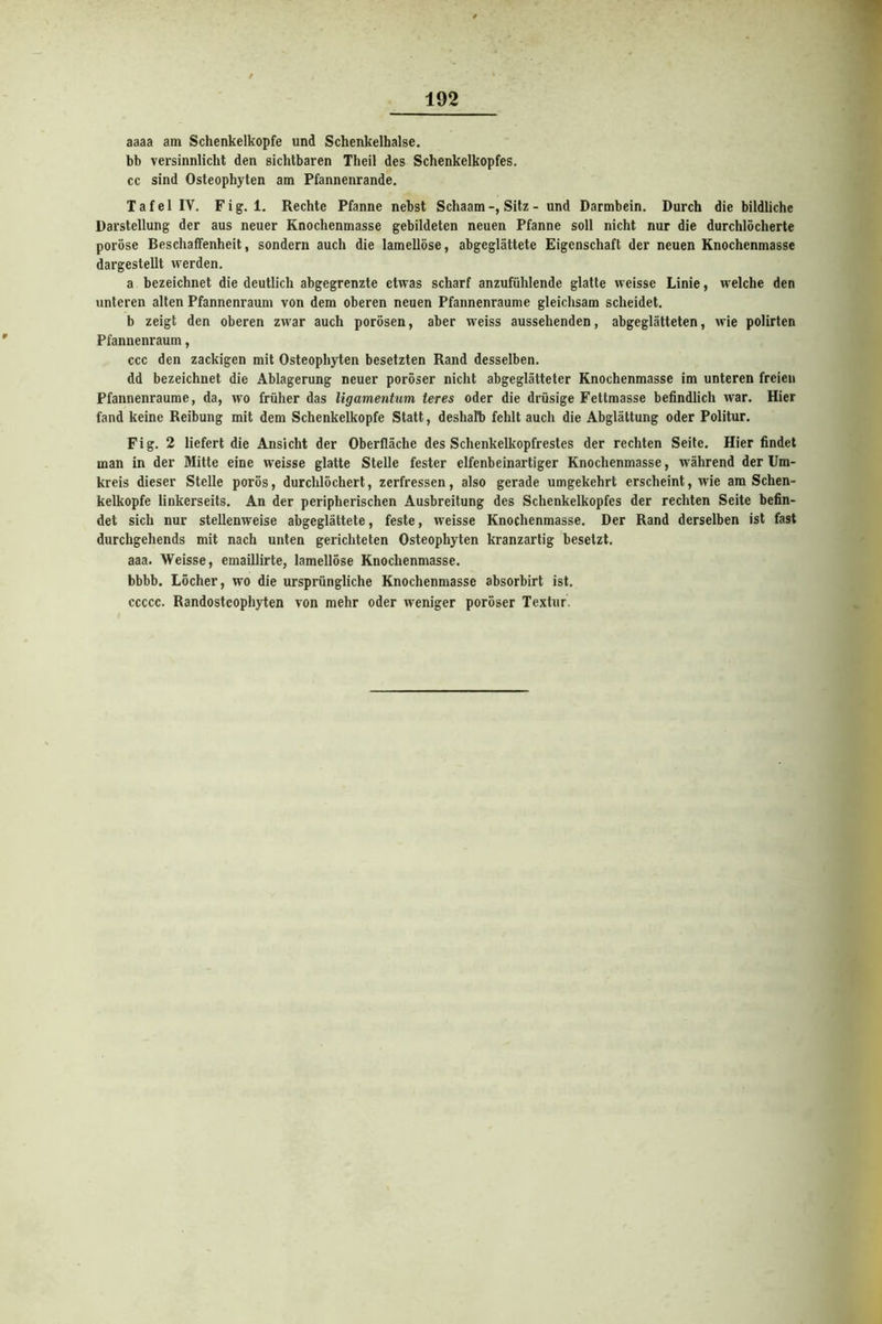 aaaa am Schenkelkopfe und Schenkelhälse, bb versinnlicht den sichtbaren Theil des Schenkelkopfes, cc sind Osteophyten am Pfannenrande. T a f e 1 IV. F i g. 1. Rechte Pfanne nebst Schaam Sitz - und Darmbein. Durch die bildliche Darstellung der aus neuer Knochenmasse gebildeten neuen Pfanne soll nicht nur die durchlöcherte poröse Beschaffenheit, sondern auch die lamellöse, abgeglättete Eigenschaft der neuen Knochenmasse dargestellt werden. a bezeichnet die deutlich abgegrenzte etwas scharf anzufühlende glatte weissc Linie, welche den unteren alten Pfannenraum von dem oberen neuen Pfannenraume gleichsam scheidet. b zeigt den oberen zwar auch porösen, aber weiss aussehenden, abgeglätteten, wie polirten Pfannenraum, ccc den zackigen mit Osteophyten besetzten Rand desselben. dd bezeichnet die Ablagerung neuer poröser nicht abgeglätteter Knochenmasse im unteren freien Pfannenraume, da, wo früher das ligamentum teres oder die drüsige Fettmasse befindlich war. Hier fand keine Reibung mit dem Schenkelkopfe Statt, deshalb fehlt auch die Abglättung oder Politur. Fig. 2 liefert die Ansicht der Oberfläche des Schenkelkopfrestes der rechten Seite. Hier findet man in der Mitte eine weisse glatte Stelle fester elfenbeinartiger Knochenmasse, während der Um- kreis dieser Stelle porös, durchlöchert, zerfressen, also gerade umgekehrt erscheint, wie am Schen- kelkopfe linkerseits. An der peripherischen Ausbreitung des Schenkelkopfes der rechten Seite befin- det sich nur stellenweise abgeglättete, feste, weisse Knochenmasse. Der Rand derselben ist fast durchgehends mit nach unten gerichteten Osteophyten kranzartig besetzt, aaa. Weisse, emaillirte, lamellöse Knochenmasse, bbbb. Löcher, wo die ursprüngliche Knochenmasse absorbirt ist. ccccc. Randosteophyten von mehr oder weniger poröser Textur