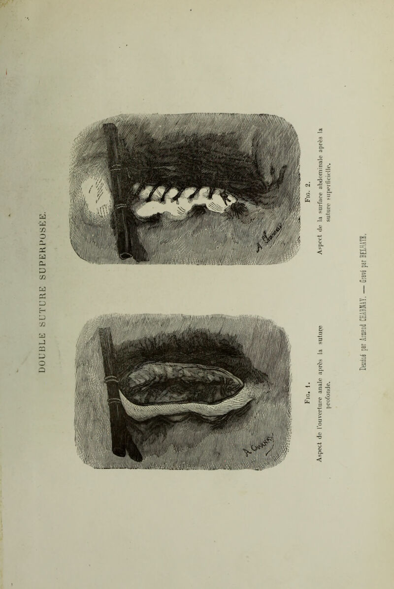 DOUBLE SUTURE SUPERPOSÉE. i Fig. 1. Fig. 2. Aspect de l’ouverture anale après la suture Aspect de la surface abdominale après la profonde. suture superficielle.