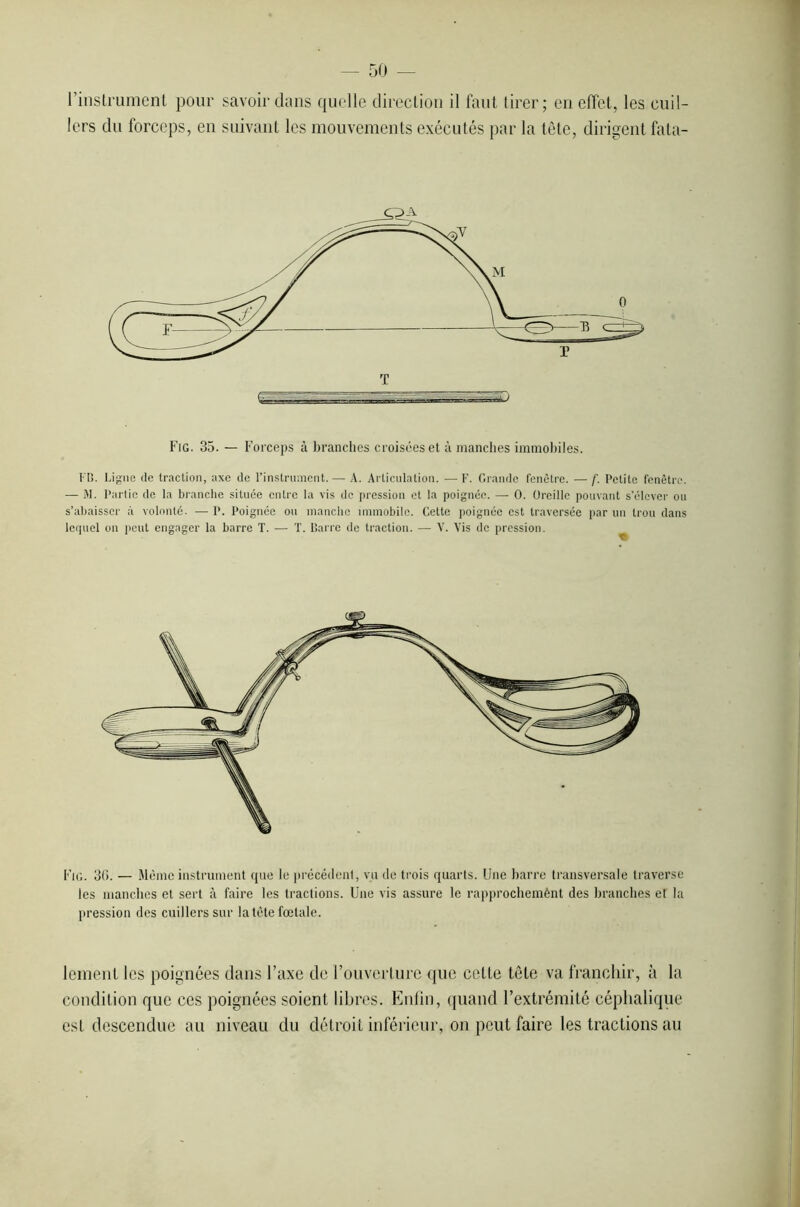 l’instrument pour savoir dans quelle direction il faut tirer; en efïet, les cuil- lers du forceps, en suivant les mouvements exécutés par la tête, dirigent fata- o .. . Fig. 35. — Forceps à branches croisées et à manches immobiles. MI. Ligne de traction, axe de l’instrument.— A. Articulation. —F. Grande fenêtre. —f. Petite fenêtre. — M. Partie de la branche située entre la vis de pression et la poignée. — 0. Oreille pouvant s’élever ou s’abaisser à volonté. — P. Poignée ou manche immobile. Cette poignée est traversée par un trou dans lequel on peut engager la barre T. — T. Barre de traction. — V. Vis de pression. Fig. 30. — Même instrument que le précédent, vu de trois quarts. Une barre transversale traverse les manches et sert à faire les tractions. Une vis assure le rapprochemènt des branches el la pression des cuillers sur la tète fœtale. lement les poignées dans l’axe de l’ouverture que celle tôle va franchir, à la condition que ces poignées soient libres. Enfin, quand l’extrémité céphalique est descendue au niveau du détroit inférieur, on peut faire les tractions au