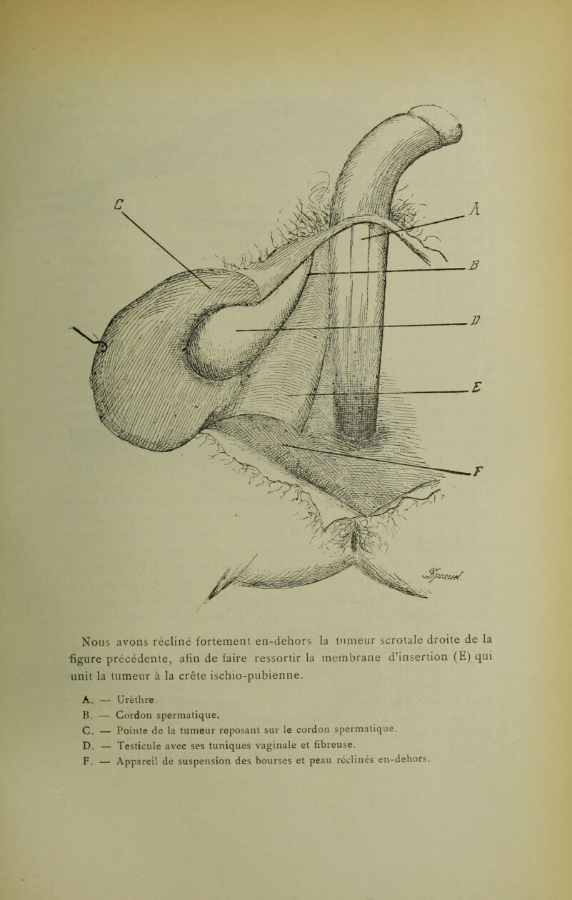 Nous avons récliné fortement en-dehors la tumeur scrotale droite de la figure précédente, afin de faire ressortir la membrane d’insertion (E) qui unit la tumeur à la crête ischio-pubienne. A. — Urèthre B. — Cordon spermatique. C. — Pointe de la tumeur reposant sur le cordon spermatique. D. — Testicule avec ses tuniques vaginale et fibreuse. F. — Appareil de suspension des bourses et peau réclinés en-dehors.
