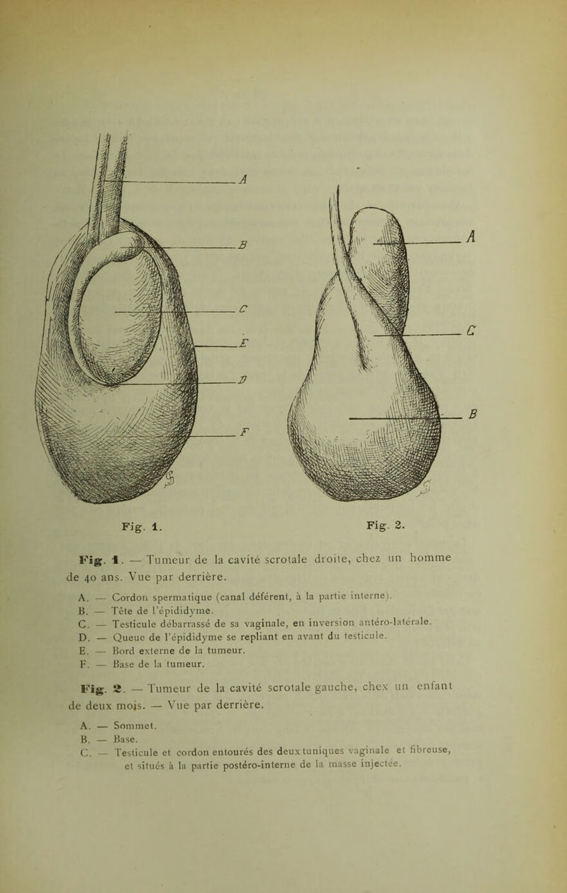 A c B Fig. \ . — Tumeur de la cavité scrotale droite, chez un homme de 40 ans. Vue par derrière. A. — Cordon spermatique (canal déférent, à la partie interne). H. — Tête de l’épididyme. C. — Testicule débarrassé de sa vaginale, en inversion antero-latérale. D. — Queue de l’épididyme se repliant en avant du testicule. E. — Bord externe de la tumeur. F. — Base de la tumeur. Fig. 2. — Tumeur de la cavité scrotale gauche, chex un enfant de deux mois. — Vue par derrière. A. — Sommet. B. — Base. C. — Testicule et cordon entourés des deuxtuniques vaginale et fibreuse, et situés à la partie postéro-interne de la masse injectée.