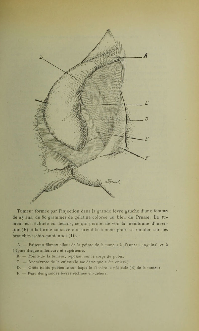 Tumeur formée par l’injection dans la grande lèvre gauche d’une femme de 25 ans, de 80 grammes de gélatine colorée au bleu de Prusse. La tu- meur est réclinée en-dedans, ce qui permet de voir la membrane d’inser- tion (E) et la forme concave que prend la tumeur pour se mouler sur les branches ischio-pubiennes (D). A. — Faisceau fibreux allant de la pointe de la tumeur à l’anneau inguinal et à l’épine iliaque antérieure et supérieure. B. — Pointe de la tumeur, reposant sur le corps du pubis. C. — Aponévrose de la cuisse (le sac dartoïque a été enlevé). D. — Crête ischio-pubienne sur laquelle s'insère le pédicule (E) de la tumeur. F. — Peau des grandes lèvres réclinée en-dehors.