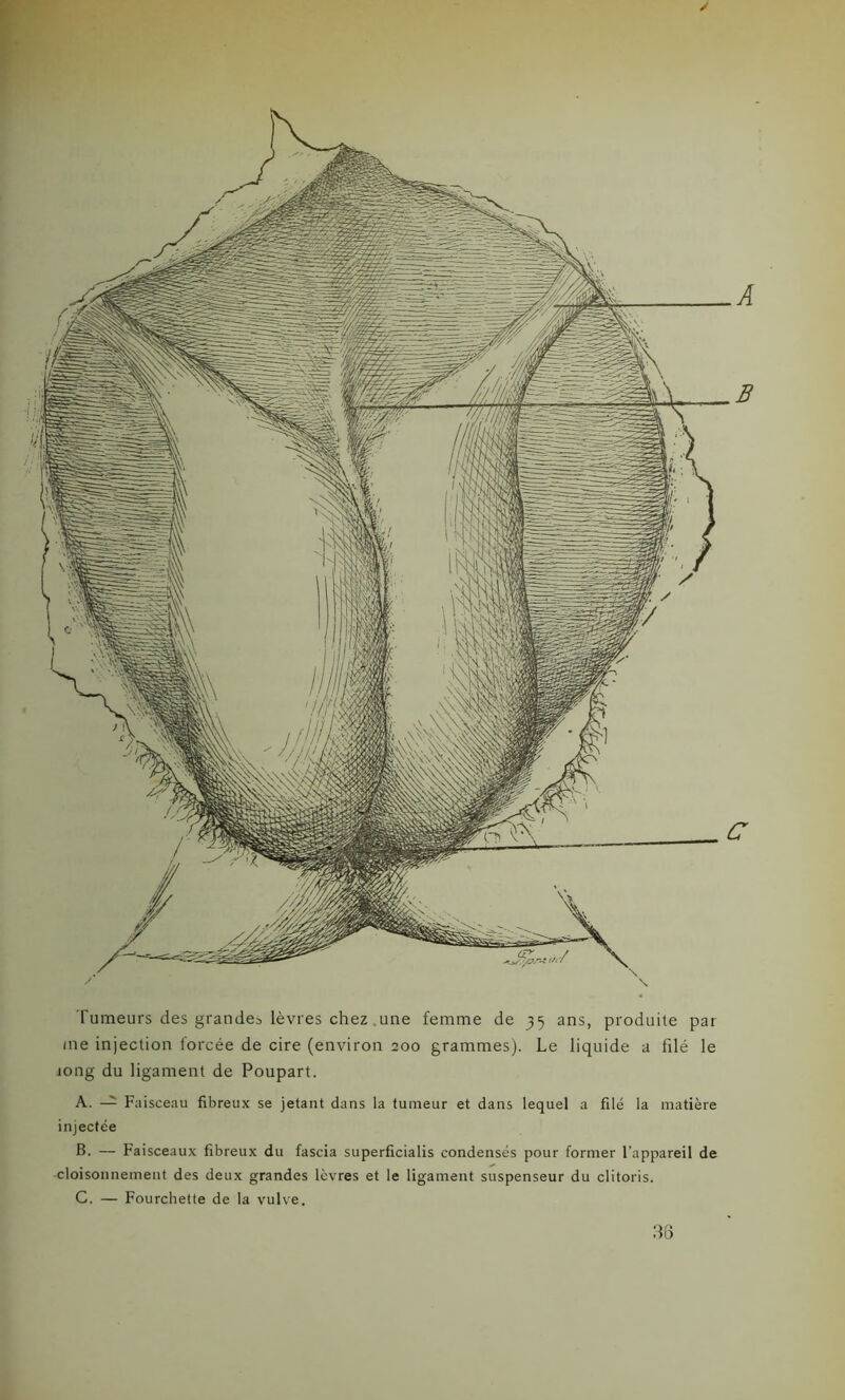 Tumeurs des grandes lèvres chez une femme de 35 ans, produite par me injection forcée de cire (environ 200 grammes). Le liquide a filé le long du ligament de Poupart. A. — Faisceau fibreux se jetant dans la tumeur et dans lequel a filé la matière injectée B. — Faisceaux fibreux du fascia superficialis condensés pour former l’appareil de cloisonnement des deux grandes lèvres et le ligament suspenseur du clitoris. C. — Fourchette de la vulve. 36