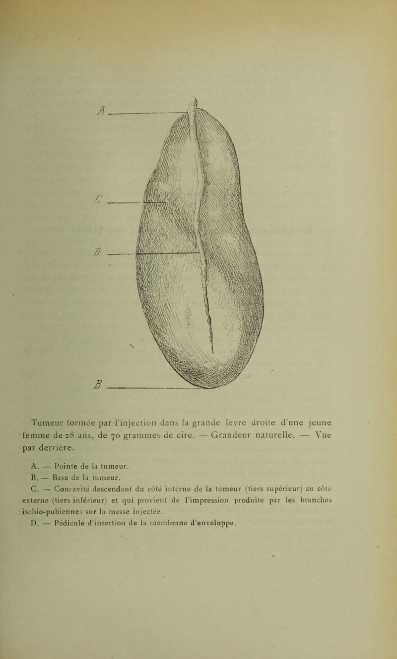 A c i1 B Tumeur formée par l’injection dans la grande lèvre droite d’une jeune femme de 28 ans, de 70 grammes de cire. — Grandeur naturelle. —- Vue par derrière. A. — Pointe de la tumeur. B. — Base de la tumeur. C. — Concavité descendant du côté interne de la tumeur (tiers supérieur) au côté externe (tiers inférieur) et qui provient de l’impression produite par les branches ischio-pubiennes sur la masse injectée. D. — Pédicule d’insertion de la membrane d’enveloppe.