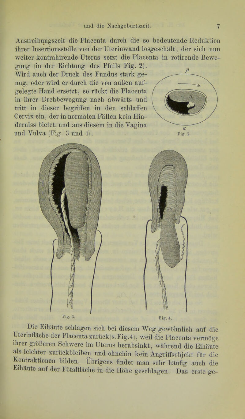 Austreibungszeit die Placenta durch die so bedeutende Reduktion ihrer Insertionsstelle von der Uterinwand losgeschält, der sich nun weiter kontrahirende Uterus setzt die Placenta in rotirende Bewe- gung in der Richtung des Pfeils Fig. 2). Wird auch der Druck des Fundus stark ge- nug, oder wird er durch die von außen auf- gelegte Hand ersetzt, so rückt die Placenta in ihrer Drehbewegung nach abwärts und tritt in dieser begriffen in den schlaffen Cervix ein, der in normalen Fällen kein Hin- derniss bietet, und aus diesem in die Vagina imd Vulva (Fig. 3 und 4). Fig. 2. 3. Fig. 4. Die Fihäute schlagen sich bei diesem Weg gewöhnlicli auf die Uterinfläche der Placenta zurück(s.Fig.4), weil die Placenta vermöge ihrer pößereu Schwere im Uterus herabsinkt, während die Eihäute als leichter Zurückbleiben und ohnehin kein Angriffsobjekt für die Kontraktionen bilden. Übrigens findet man sehr häufig auch die Eihäute auf der Fötalfläclie in die Höhe geschlagen. Das erste ge-