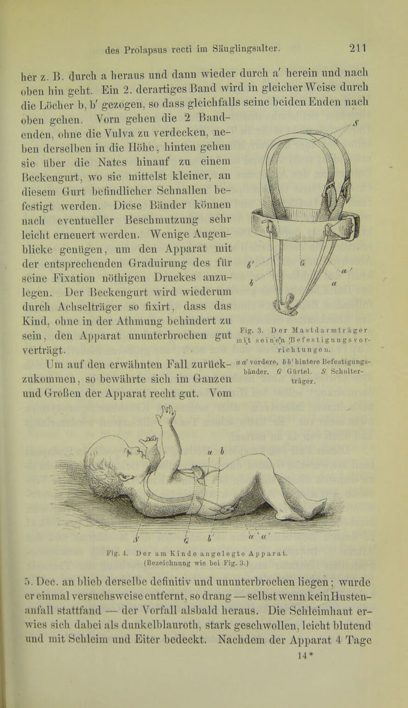 her z. B. (lurch a heraiis und dann wieder durch a' herein und nach oben liin geht. Ein 2. derartiges Band wird in gleicherweise durch die Löcher b, b' gezogen, so dass gleichfalls seine beiden Enden nacb oben geben. Vorn geben die 2 Band- ^ enden, obne die Vulva zu verdecken, ne- ben derselben in die Höbe, binten gehen sie^ über die Nates hinauf zu einem Beckengurt, wo sie mittelst kleiner, an diesem Gurt befindlicher Schnallen be- festigt werden. Diese Bänder können nacb eventueller Beschmutzung sehr leicht erneuert werden. Wenige Augen- blicke genügen, um den Apparat mit der entspreebenden Graduirung des für seine Fixation nöthigen Druckes anzu- legeu. Der Beckeugurt wird wiederum durch Achselträger so fixirt, dass das Kind, ohne in der Athmung behindert zu sein, den Apparat ununterbrochen gut verträgt. Um auf den erwähnten Fall zurück- zukommen, so bewährte sich im Ganzen und Großen der A])parat recht gut. Vom Fig. 3. Der ]\I a s t d a r m t r fi g e r ini't seine]n |B ef es 1,i gn n gs Vor- richtungen. a o' vordere, b b' hintere Befestigungs- bänder. G Gürtel. S Schulter- träger. Fig. 1. Der am Kinde angelegte Apparat. (Bezeichnung wie bei Fig. 3.) 5. Dcc. an blieb derselbe definitiv und ununterbroeben liegen; wurde er einmal versuchsweise entfernt, so drang — selbst wenn keinllusten- anf'all stattfand — der Vorfall alsbald heraus. Die Schleimhaut er- wies sich dabei als dunkcllilauroth, stark geschwollen, leicht blutend und mit Scbleim und Eiter bedeckt. Nachdem der Apparat 4 Tage 14*