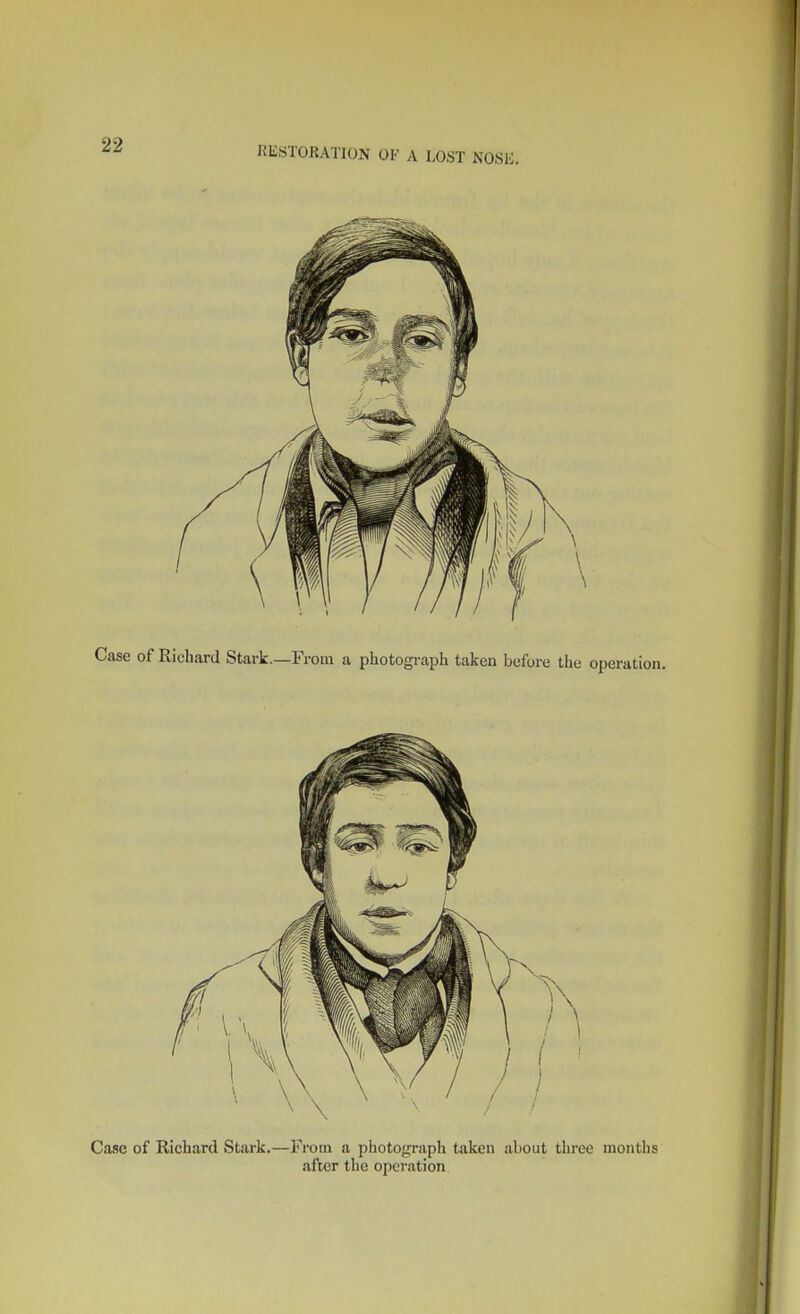 Case of Richard Stark.—From a photograph taken about three months