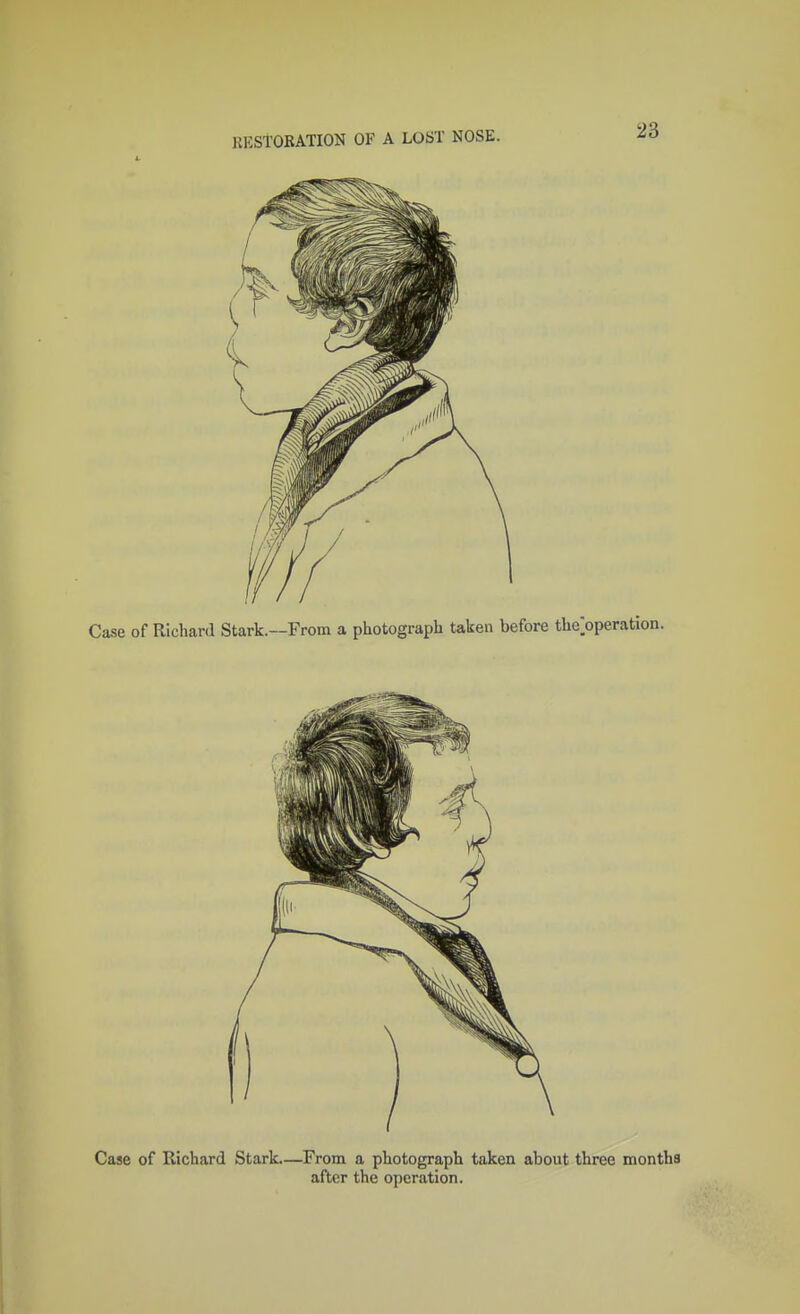 Case of Richard Stark—From a photograph taken about three months