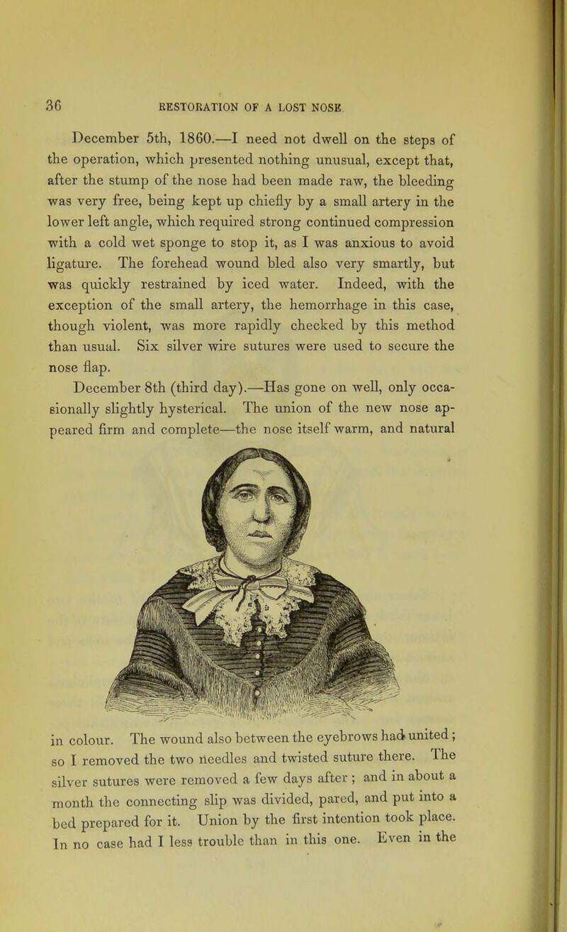 December 5th, 1860.—I need not dwell on the steps of the operation, which presented nothing unusual, except that, after the stump of the nose had been made raw, the bleeding was very free, being kept up chiefly by a small artery in the lower left angle, which required strong continued compression with a cold wet sponge to stop it, as I was anxious to avoid ligature. The forehead wound bled also very smartly, but was quickly restrained by iced water. Indeed, with the exception of the small artery, the hemorrhage in this case, though violent, was more rapidly checked by this method than usual. Six silver wire sutures were used to secure the nose flap. December 8th (third day).—Has gone on well, only occa- sionally slightly hysterical. The union of the new nose ap- peared firm and complete—the nose itself warm, and natural in colour. The wound also between the eyebrows had united; so I removed the two needles and twisted suture there. The silver sutures were removed a few days after ; and in about a month the connecting slip was divided, pared, and put into a bed prepared for it. Union by the first intention took place. In no case had I less trouble than in this one. Even in the