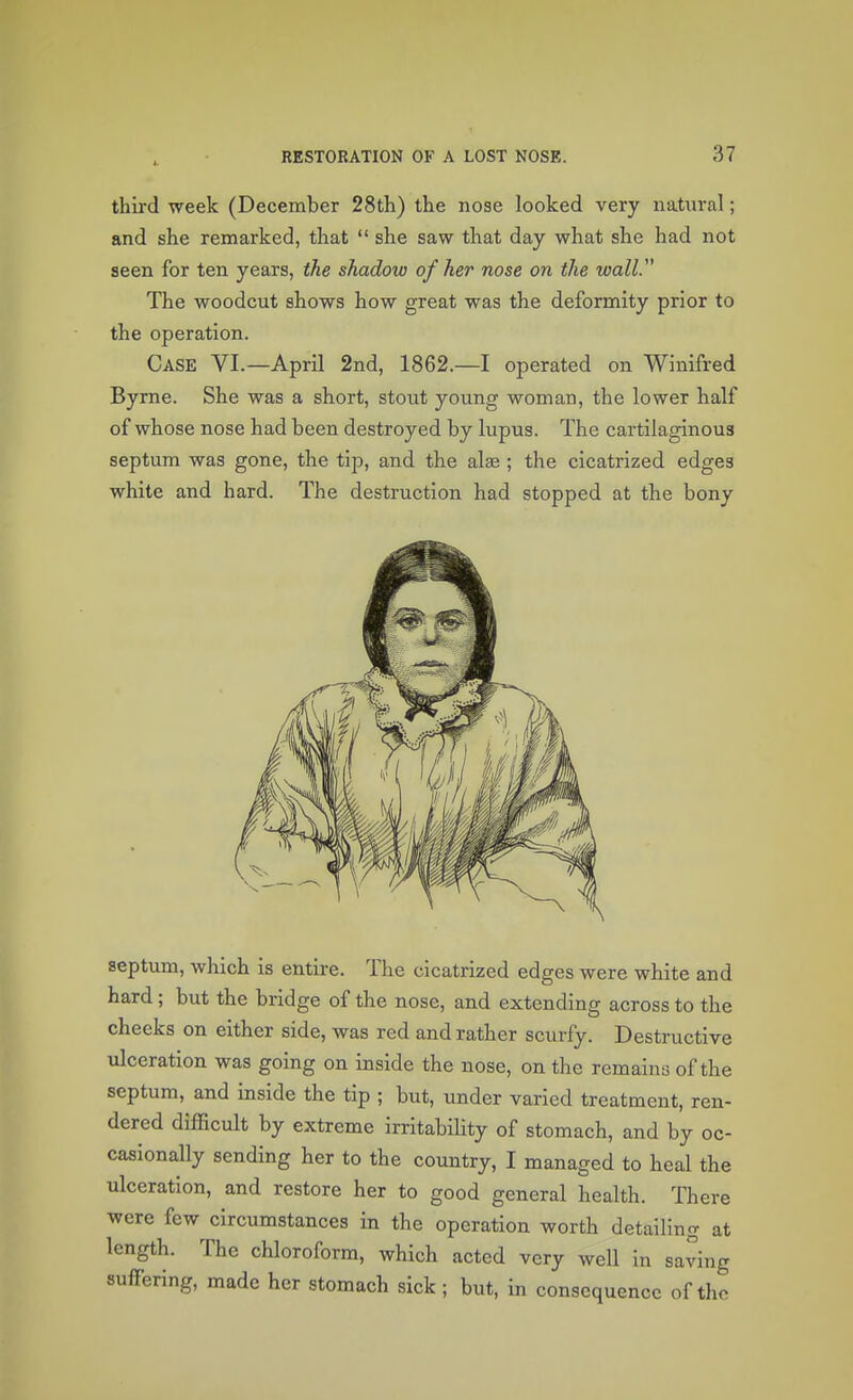 third week (December 28th) the nose looked very natural; and she remarked, that  she saw that day what she had not seen for ten years, the shadow of her nose on the wall. The woodcut shows how great was the deformity prior to the operation. Case VI.—April 2nd, 1862.—I operated on Winifred Byrne. She was a short, stout young woman, the lower half of whose nose had been destroyed by lupus. The cartilaginous septum was gone, the tip, and the alae ; the cicatrized edges white and hard. The destruction had stopped at the bony septum, which is entire. The cicatrized edges were white and hard; but the bridge of the nose, and extending across to the cheeks on either side, was red and rather scurfy. Destructive ulceration was going on inside the nose, on the remains of the septum, and inside the tip ; but, under varied treatment, ren- dered difficult by extreme irritability of stomach, and by oc- casionally sending her to the country, I managed to heal the ulceration, and restore her to good general health. There were few circumstances in the operation worth detailing at length. The chloroform, which acted very well in saving suffering, made her stomach sick; but, in consequence of the