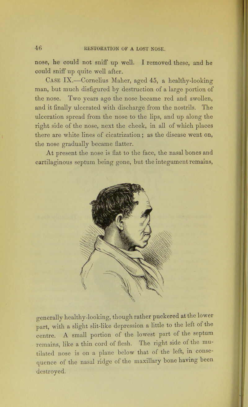 nose, he could not sniff up well. I removed these, and he could sniff up quite -well after. CASE IX.—Cornelius Maher, aged 45, a healthy-looking man, but much disfigured by destruction of a large portion of the nose. Two years ago the nose became red and swollen, and it finally ulcerated with discharge from the nostrils. The ulceration spread from the nose to the hps, and up along the right side of the nose, next the cheek, in all of which places there are white lines of cicatrization; as the disease went on, the nose gradually became flatter. At present the nose is flat to the face, the nasal bones and cartilaginous septum being gone, but the integument remains, generally healthy-looking, though rather puckered at the lower part, with a slight slit-like depression a little to the left of the centre. A small portion of the lowest part of the septum remains, like a thin cord of flesh. The right side of the mu- tilated nose is on a plane below that of the left, in conse- quence of the nasal ridge of the maxillary bone having been destroyed.