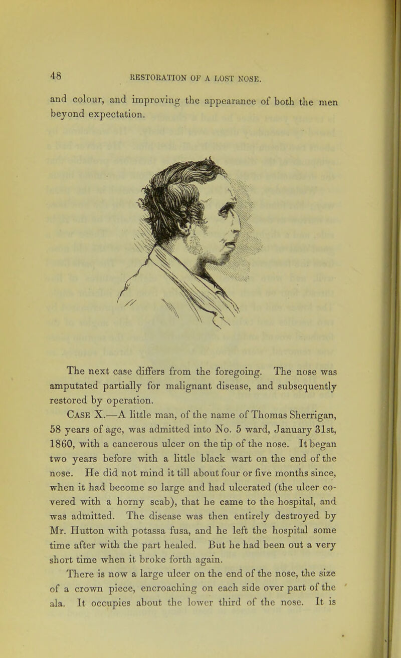 and colour, and improving the appearance of both the men beyond expectation. The next case differs from the foregoing. The nose was amputated partially for malignant disease, and subsequently restored by operation. Case X.—A little man, of the name of Thomas Sherrigan, 58 years of age, was admitted into No. 5 ward, January 31st, 1860, with a cancerous ulcer on the tip of the nose. It began two years before with a little black wart on the end of the nose. He did not mind it till about four or five months since, when it had become so large and had ulcerated (the ulcer co- vered with a horny scab), that he came to the hospital, and was admitted. The disease was then entirely destroyed by Mr. Hutton with potassa fusa, and he left the hospital some time after with the part healed. But he had been out a very short time when it broke forth again. There is now a large ulcer on the end of the nose, the size of a crown piece, encroaching on each side over part of the ala. It occupies about the lower third of the nose. It is