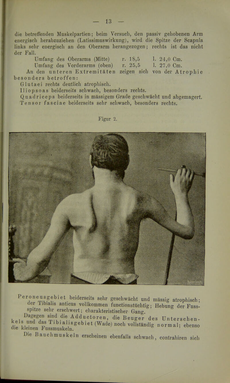 die betreffenden Muskelpartien; beim Versuch, den passiv gehobenen Arm energisch herabzuziehen (Latissimuswirkung), wird die Spitze der Scapula links sehr energisch an den Oberarm herangezogen; rechts ist das nicht der Fall. Umfang des Oberarms (Mitte) r. 18,5 1. 24,0 Cm. Umfang des Vorderarms (oben) r. 25,5 I. 27,0 Cm. An den unteren Extremitäten zeigen sich von der Atrophie besonders betroffen: Glutaei rechts deutlich atrophisch. Iliopsoas beiderseits schwach, besonders rechts. Quadriceps beiderseits in massigem Grade geschwächt und abgemagert. Tensor fasciae beiderseits sehr schwach, besonders rechts. Figur 2. Peroneusgeb.et beiderseits sehr geschwächt und mässig atrophisch; der Tibial.s anticus vollkommen functionstiichtig; Hebung der Fnss- spitze sehr erschwert; charakteristischer Gang k.l/Ä 8;ndKdi« AddLuctoren, die Beuger des Unterschen- Sielk,e?nendFusru:keln.Sebiet ^ ~* *™ Die Bauchmuskeln erscheinen ebenfalls scliwach, contraliiren sich