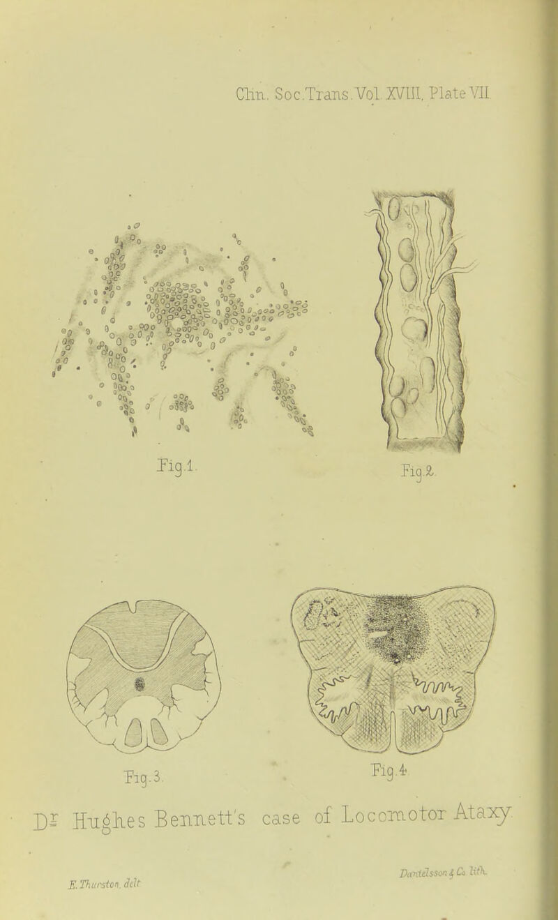 Clm. Soc.Trans.Vol XVIIl, Plate W Hiiglies Bennett's case of Locomotor Ataxy E. Thurston. Belt
