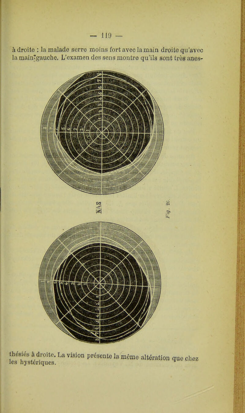 à droite : la malade serre moins fort avec la main droite qu'avec la main'gauche. L'examen des sens montre qu'ils sont très anes- I