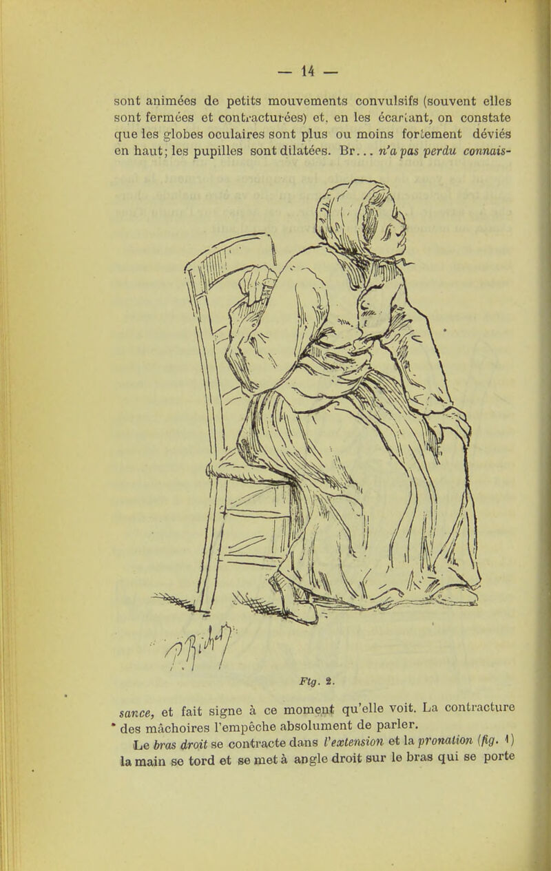 sont animées de petits mouvements convulsifs (souvent elles sont fermées et contracturées) et. en les écartant, on constate que les globes oculaires sont plus ou moins foriement déviés en haut; les pupilles sont dilatées. Br... n'a pas perdu connais- Ftg. 2. sance, et fait signe à ce momen* qu'elle voit. La contracture * des mâchoires l'empêche absolument de parler. Le bras droit se contracte dans Vextension et la pronalion (fig. 1 ) la main se tord et se met à angle droit sur le bras qui se porte