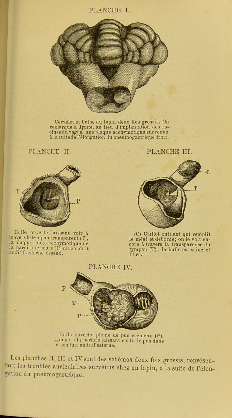 PLANCHE I. Cervelet et bulbe du Ifipiu deux Cois grossis. On remarque à droite, au lieu d'implantation des ra- cines du vague', une plaque ecchymotique survenue à la suite de l'élongation du pneumogastrique droit. PLANCHE n. PLANCHE lU. Bulle ouverte laissant voir à travers le tympan transparent (T), la plaque rouge ecchymotique de la paroi inférieure (P) du conduit auditif externe osseux. (C) Caillot rutilant qui remplit le méat et débordej on le voit en- core à travers la transparence du tympan (T) ; la bulle est saine et libre. PLANCHE IV. Bulle ouverte, pleine de pus crème-ix (P), îympaii (T; perforé laissant sortir le pus dans le con iuit auditif externe. Les planches H, HI et IV sont des schémas deux fois grossis, représen- tant les troubles auriculaires survenus chez un lapin, à la suite de l'élon- gation du pneumogastrique.