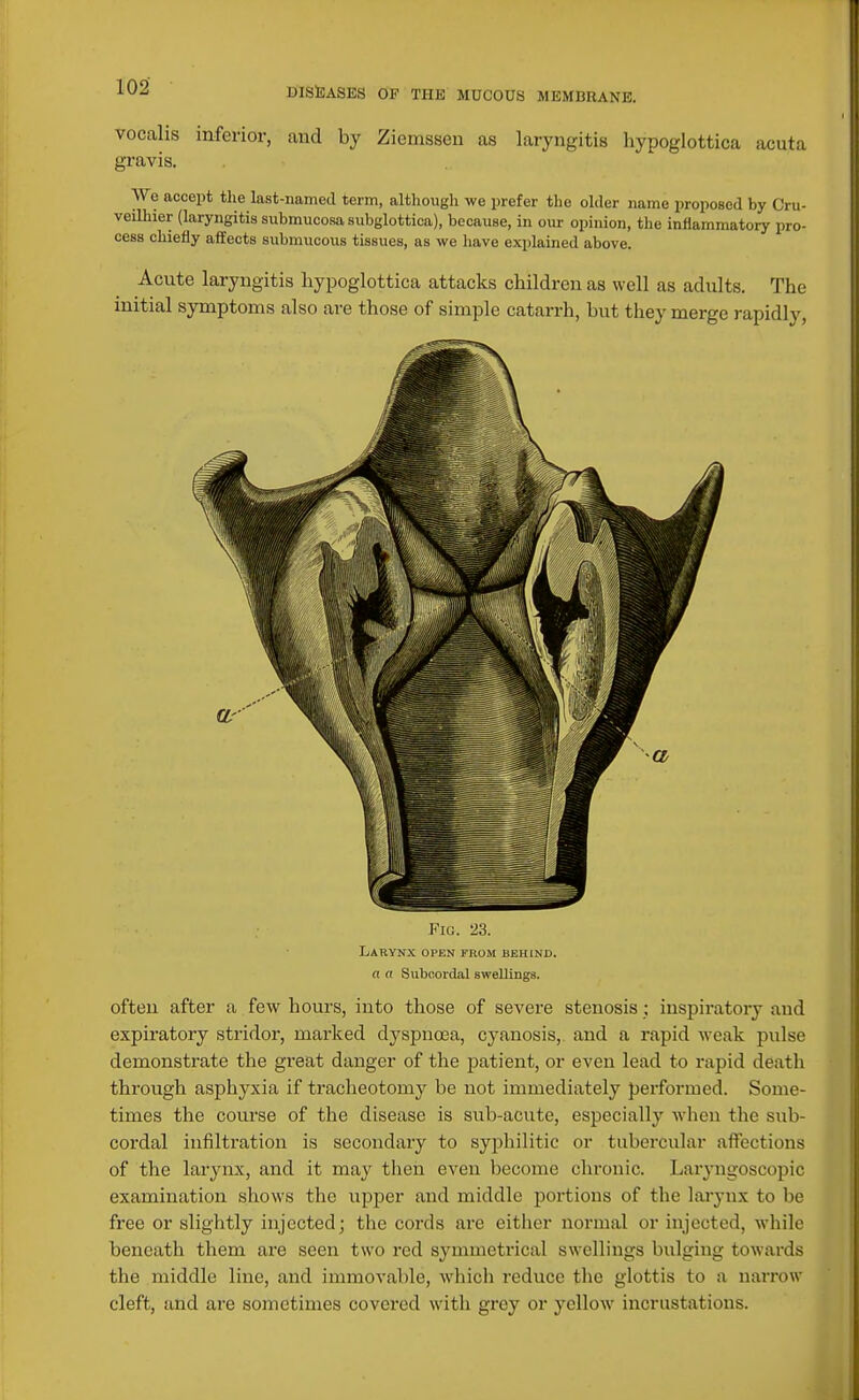 vocalis inferior, and by Ziemssen as laryngitis hypoglottica acuta gravis. We accept the last-named term, althougli we prefer the ohler name proposed by Cru- veilhier (laryngitis submucosa subglottica), because, in our opinion, the inflammatory pro- cess chiefly affects submucous tissues, as we liave explained above. Acute laryngitis hypoglottica attacks children as well as adults. The initial symptoms also are those of simple catarrh, but they merge rapidly. KiG. 23. Larynx open from behind. a a Suboordal swellings. often after a few hours, into those of severe stenosis ; inspiratory and expiratory stridor, marked dyspnasa, cyanosis,, and a rapid weak pulse demonstrate the great danger of the patient, or even lead to rapid death through asphyxia if tracheotomy be not immediately performed. Some- times the com'se of the disease is sub-acute, especially when the sub- cordal infiltration is secondary to syphilitic or tubercular affections of the larynx, and it may then even become chronic. Laryngoscopic examination shows the upper and middle portions of the larynx to be free or slightly injected; the cords are eitlicr normal or injected, while beneath them are seen two red symmetrical swellings bulging towards the middle line, and immovable, which reduce the glottis to a narrow cleft, and are sometimes covered with grey or yellow incrustations.