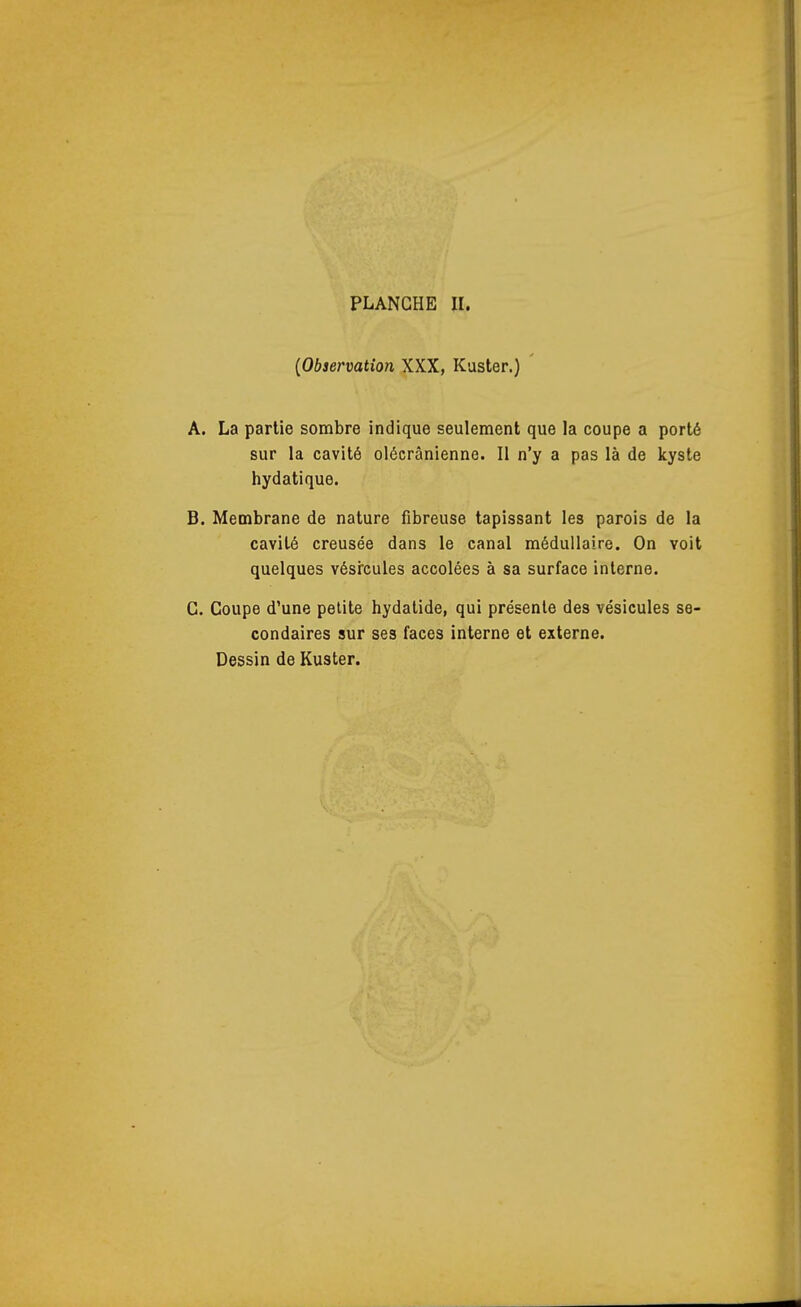 {Observation XXX, Kaster.) A. La partie sombre indique seulement que la coupe a porté sur la cavité olécrânienne. II n'y a pas là de kyste hydatique. B. Membrane de nature fibreuse tapissant les parois de la cavité creusée dans le canal médullaire. On voit quelques vésrcules accolées à sa surface interne. C. Coupe d'une petite hydatide, qui présente des vésicules se- condaires sur ses faces interne et externe. Dessin de Kuster.