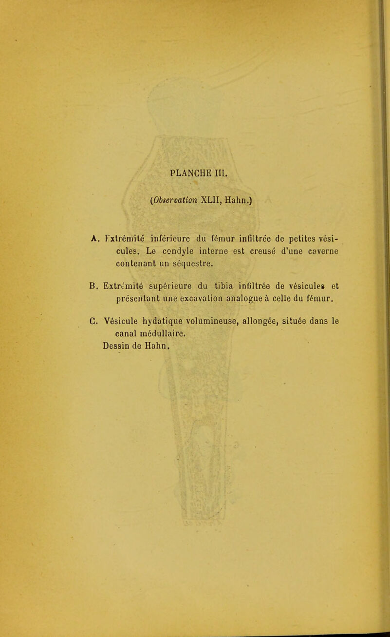 (Observation XLII, Hahn.) A. Kxlrémilé inférieure du fémur infiltrée de petites vési- cules. Le condyle interne est creusé d'une caverne contenant un séquestre. B. Extrémité supérieure du tibia infiltrée de vésicules et présentant une excavation analogue à celle du fémur. C. Vésicule hydatique volumineuse, allongée, située dans le canal médullaire. Dessin de Hahn.