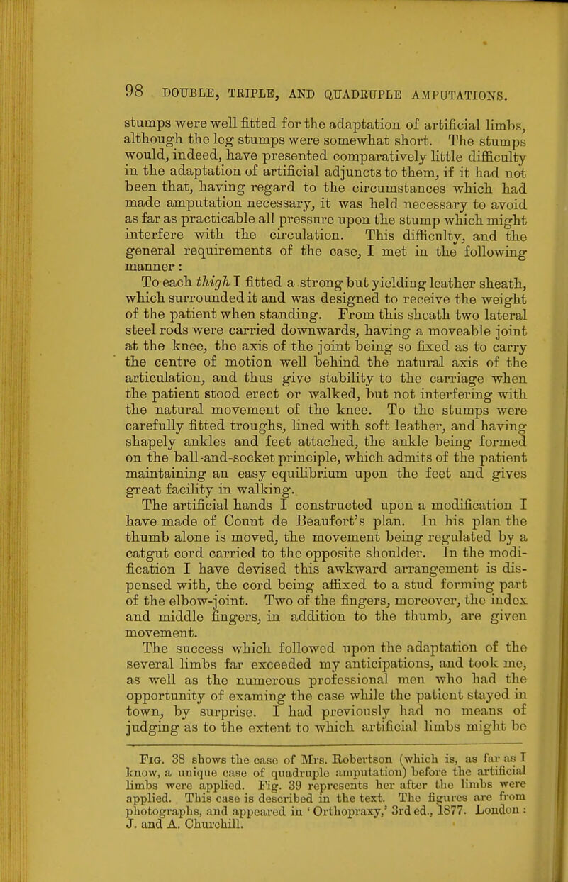 stumps were well fitted for the adaptation of artificial limbs, althoiagk tlie leg stumps were somewliat short. Tlie stumps would, indeed, have presented comparatively little difficulty in the adaptation of artificial adjuncts to them, if it had not been that, having regard to the circumstances which had made amputation necessary, it was held necessary to avoid as far as practicable all pressure upon the stump which might interfere with the circulation. This difficulty, and the general requirements of the case, I met in the following manner: To each thigh I fitted a strong but yielding leather sheath, which surrounded it and was designed to receive the weight of the patient when standing. From this sheath two lateral steel rods were carried downwards, having a moveable joint at the knee, the axis of the joint being so fixed as to carry the centre of motion well behind the natural axis of the articulation, and thus give stability to the carriage when the patient stood erect or walked, but not interfering with the natural movement of the knee. To the stumps were carefully fitted troughs, lined with soft leather, and having shapely ankles and feet attached, the ankle being formed on the ball-and-socket principle, which admits of the patient maintaining an easy equilibrium upon the feet and gives great facility in walking. The artificial hands I constructed upon a modification I have made of Count de Beaufort's plan. In his plan the thumb alone is moved, the movement being regulated by a catgut cord carried to the opposite shoulder. In the modi- fication I have devised this awkward arrangement is dis- pensed with, the cord being affixed to a stud foi-ming part of the elbow-joint. Two of the fingers, moreover, the index and middle fingers, in addition to the thumb, are given movement. The success which followed upon the adaptation of the several limbs far exceeded my anticipations, and took me, as well as the numerous professional men who had the opportunity of examing the case while the patient stayed in town, by surprise. I had previously had no means of judging as to the extent to which artificial limbs might be Fig. 38 shows tlie case of Mrs. Robertson (which is, as far as I know, a unique case of quadruple amputation) before the artificial limbs were applied. Fig. 39 represents her after the limbs were applied. This case is described in the text. The figures are from photographs, and appeared in 'Orthopraxy,' 3rded., 1877. London : J. and A. Churchill.