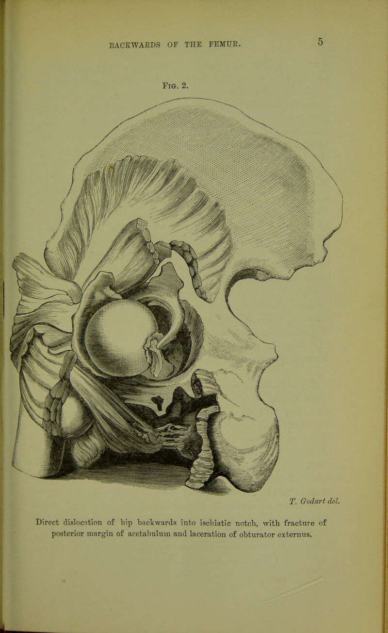 Fig. 2. T. Godart del. Direct dislocation of hip backwards into ischiatic notch, with fracture of posterior margin of acetabulum and laceration of obturator cxternus.