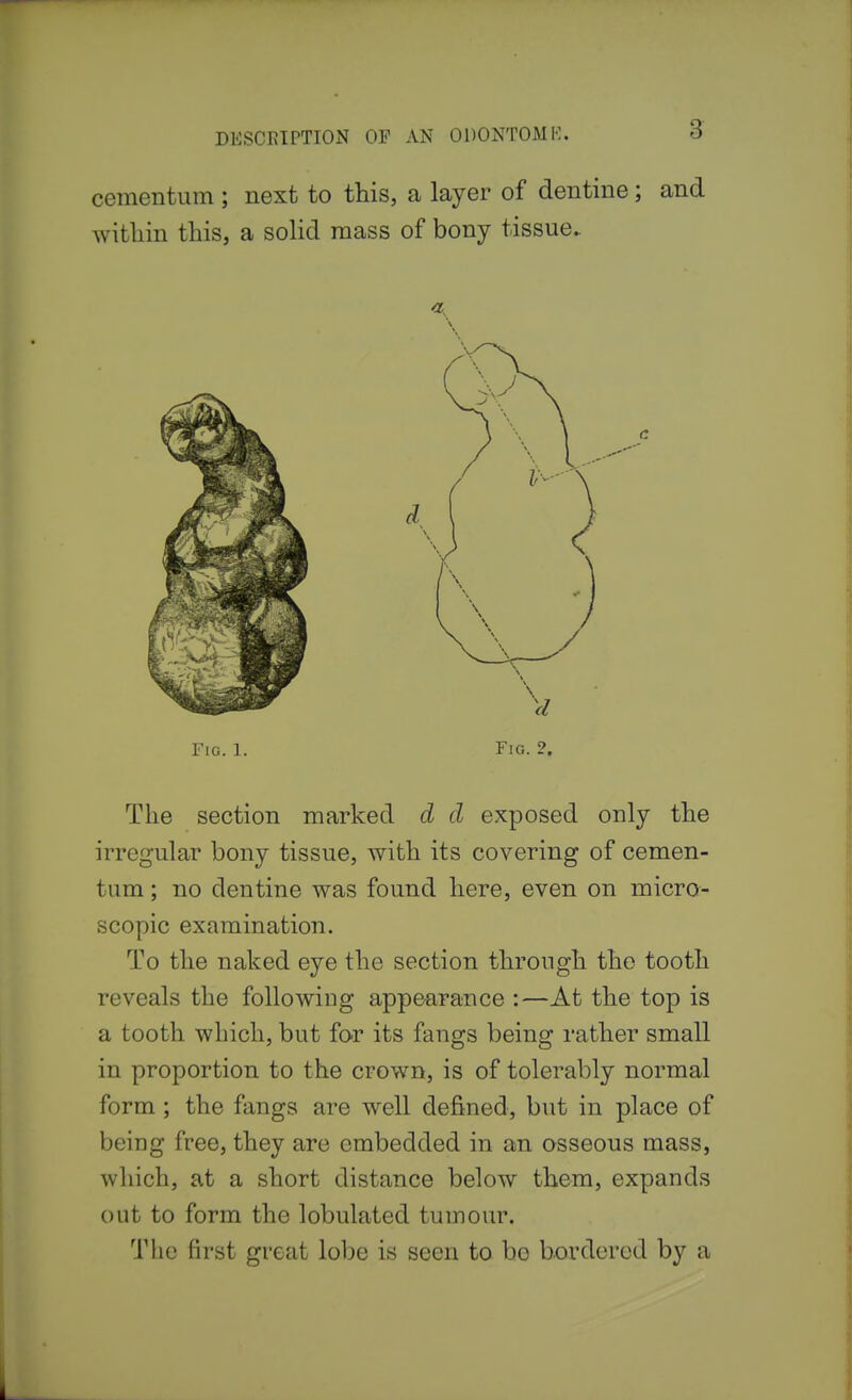 cementum ; next to this, a layer of dentine; and within this, a solid mass of bony tissue. Fig. 1. Fig. 2. The section marked d d exposed only the irregular bony tissue, with its covering of cemen- tum ; no dentine was found here, even on micro- scopic examination. To the naked eye the section through the tooth reveals the following appearance :—At the top is a tooth which, but for its fangs being rather small in proportion to the crown, is of tolerably normal form ; the fangs are well defined, but in place of being free, they are embedded in an osseous mass, which, at a short distance below them, expands out to form the lobulated tumour. The first great lobe is seen to bo bordered by a