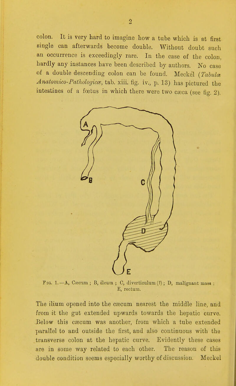 colon. It is very hard to imagine how a tube which is at first single can afterwards become double. Without doubt such an occurrence is exceedingly rare. In the case of the colon, hardly any instances have been described by authors. No case of a double descending colon can be found. Meckel (Tabulae Anatomico-Palhologicce, tab. xiii. fig. iv., p. 13) has pictured the intestines of a foetus in which there were two caeca (see fig. 2). Fni. 1.—A, Csecum ; B, ileum ; C, diverticulum (?); D, malignant mass ; E, rectum. The ilium opened into the csecum nearest the middle line, and from it the gut extended upwards towards the hepatic curve. JBelow this cascum was another, from which a tube extended parallel to and outside the first, and also continuous with the transverse colon at the hepatic curve. Evidently these cases are in some way related to each other. The reasou of this double condition seems especially worthy of discussion. Meckel