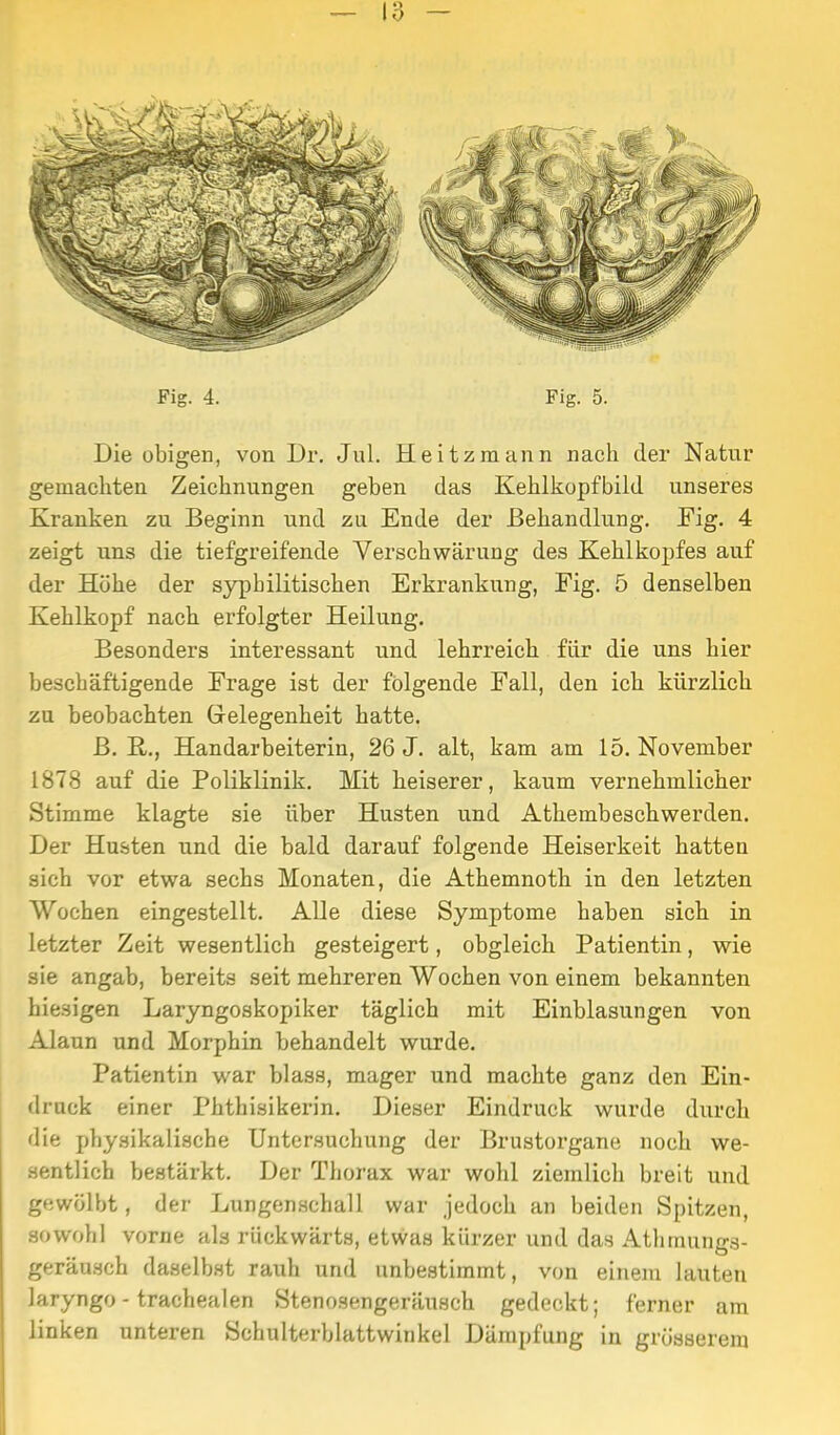 Fig. 4. Fig. 5. Die obigen, von Dr. Jul. Heitzmann nach der Natur gemacliten Zeichnungen geben das Keblkopfbild unseres Kranken zu Beginn und zu Ende der ßeliandlung. Fig. 4 zeigt uns die tiefgreifende Verschwärung des Kehlkopfes auf der Höhe der syphilitischen Erkrankung, Fig. 5 denselben Kehlkopf nach erfolgter Heilung. Besonders interessant und lehrreich für die uns hier beschäftigende Frage ist der folgende Fall, den ich kürzlich zu beobachten Gelegenheit hatte. ß. E,., Handarbeiterin, 26 J. alt, kam am 15. November 1878 auf die Poliklinik. Mit heiserer, kaum vernehmlicher Stimme klagte sie über Husten und Athembeschwerden. Der Husten und die bald darauf folgende Heiserkeit hatten sich vor etwa sechs Monaten, die Athemnoth in den letzten Wochen eingestellt. AUe diese Symptome haben sich in letzter Zeit wesentlich gesteigert, obgleich Patientin, wie sie angab, bereits seit mehreren Wochen von einem bekannten hiesigen Laryngoskopiker täglich mit Einblasungen von Alaun und Morphin behandelt wurde. Patientin war blass, mager und machte ganz den Ein- druck einer Phthisikerin. Dieser Eindruck wurde durch die physikalische Untersuchung der Brustorgane noch we- sentlich bestärkt. Der Thorax war wohl ziemlich breit und gewölbt, der Lungenschall war jedoch an beiden Spitzen, sowohl vorne als rückwärts, etwas kürzer und das Athmungs- geränsch daselbst rauh und unbestimmt, von einem lauten laryngo - trachealen Stenosengeräusch gedeckt; ferner am linken unteren Sehulterblattwinkel Dämpfung in grösserem