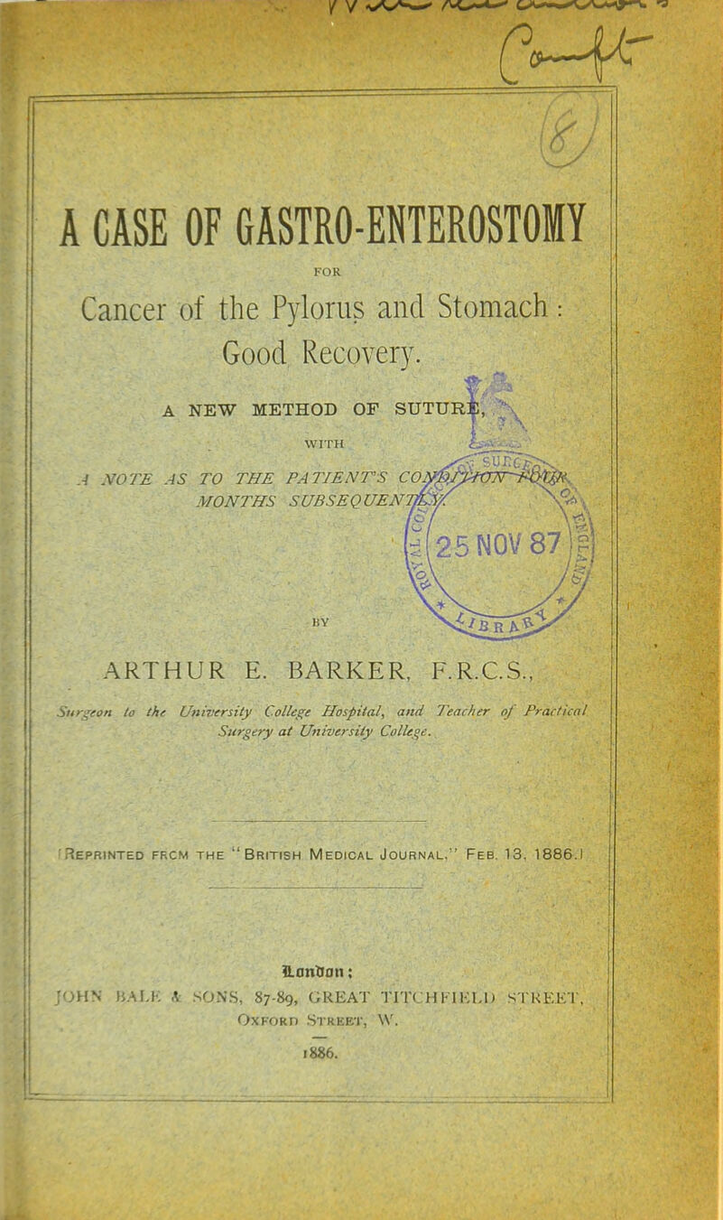 A CASE OF GASTROENTEROSTOMY FOR Cancer of the Pylorus and Stomach Good Recovery. A NEW METHOD OF SUTURE, WITH A NOTE AS TO THE PATIENTS CO MONTHS SUBSEQUEN, BY ARTHUR E. BARKER, F.R.C.S., Surgeon to the University College Hospital, and Teacher of Practical Surgery at University College.. : Reprinted frcm the ''British Medical Journal, Feb. 13. 1886.1 ILonOon: UN HA1.K A SONS, 87-89, GREAT TITCHKIEI.l) STREET, Oxford Street, \V. 1886.