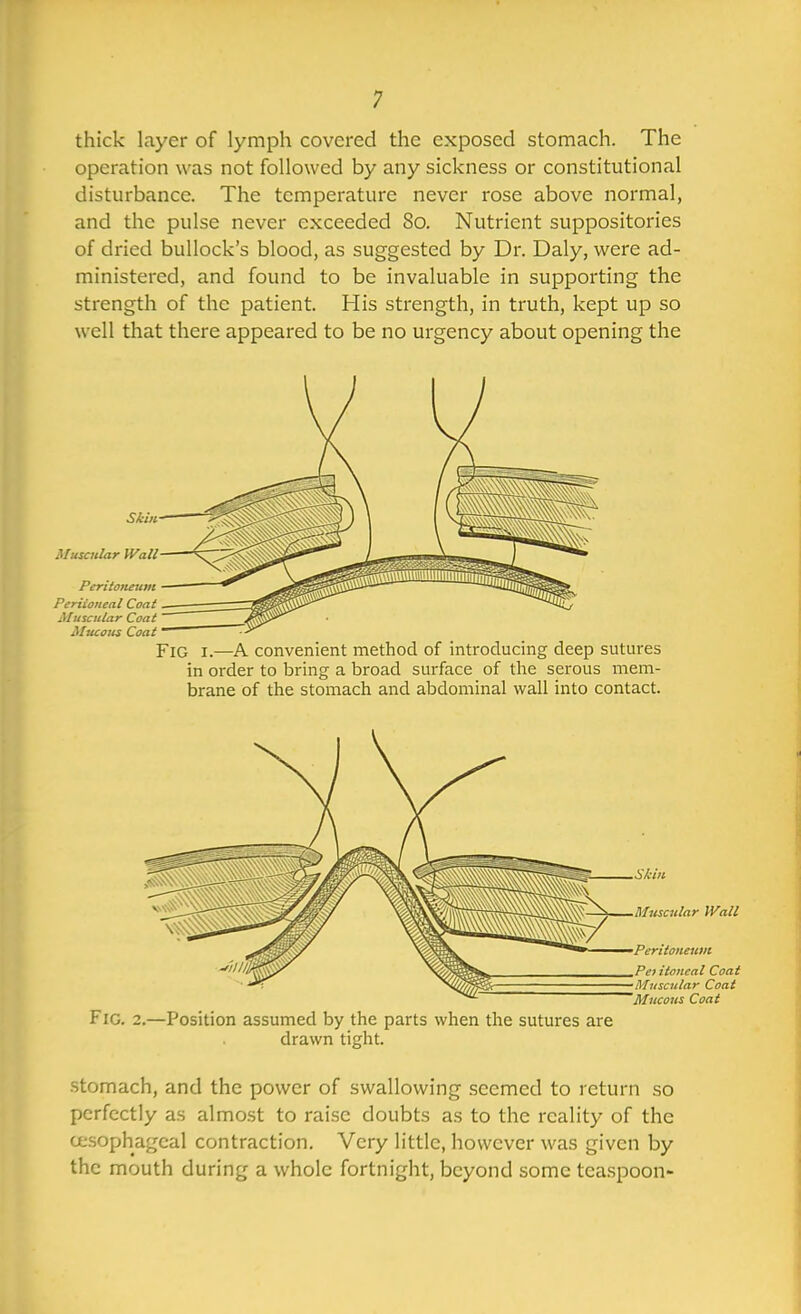 thick layer of lymph covered the exposed stomach. The operation was not followed by any sickness or constitutional disturbance. The temperature never rose above normal, and the pulse never exceeded 80. Nutrient suppositories of dried bullock's blood, as suggested by Dr. Daly, were ad- ministered, and found to be invaluable in supporting the strength of the patient. His strength, in truth, kept up so well that there appeared to be no urgency about opening the Muscular Periioneal Muscular Mucous Fig I.—A convenient method of introducing deep sutures in order to bring a broad surface of the serous mem- brane of the stomach and abdominal wall into contact. Fig. 2.—Position assumed by the parts when the sutures are drawn tight. stomach, and the power of swallowing seemed to return so perfectly as almost to raise doubts as to the reality of the cesophageal contraction. Very little, however was given by the mouth during a whole fortnight, beyond some teaspoon- Siiu Muscular Wall Peritoneum Pe> itoncai Coat Muscular Coat Mucous Coat