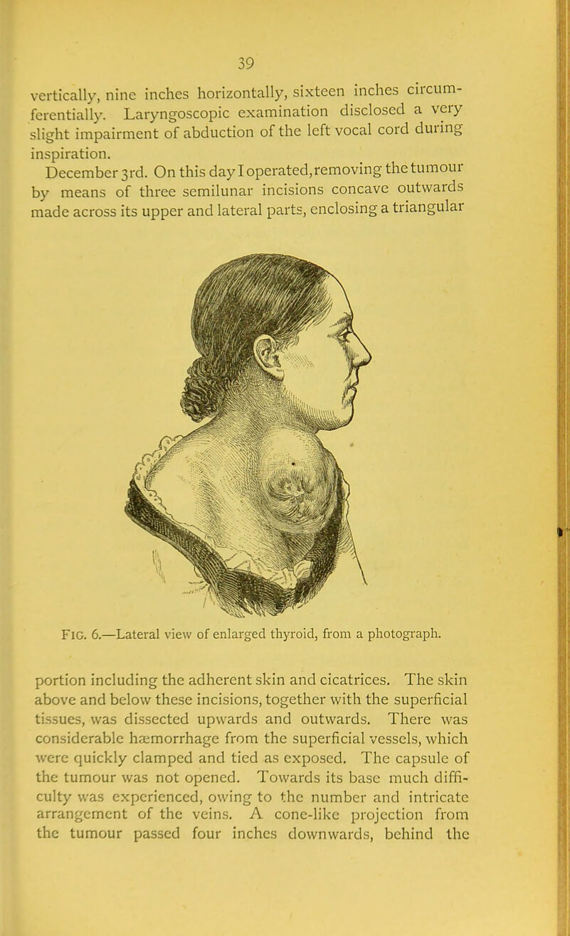 vertically, nine inches horizontally, sixteen inches circum- ferentially. Laryngoscopic examination disclosed a very slight impairment of abduction of the left vocal cord during inspiration. December 3rd. On this day I operated.removing the tumour by means of three semilunar incisions concave outwards made across its upper and lateral parts, enclosing a triangular Fig. 6.—Lateral view of enlarged thyroid, from a photograph. portion including the adherent skin and cicatrices. The skin above and below these incisions, together with the superficial tissues, was dissected upwards and outwards. There was considerable haemorrhage from the superficial vessels, which were quickly clamped and tied as exposed. The capsule of the tumour was not opened. Towards its base much diffi- culty was experienced, owing to the number and intricate arrangement of the veins. A cone-like projection from the tumour passed four inches downwards, behind the