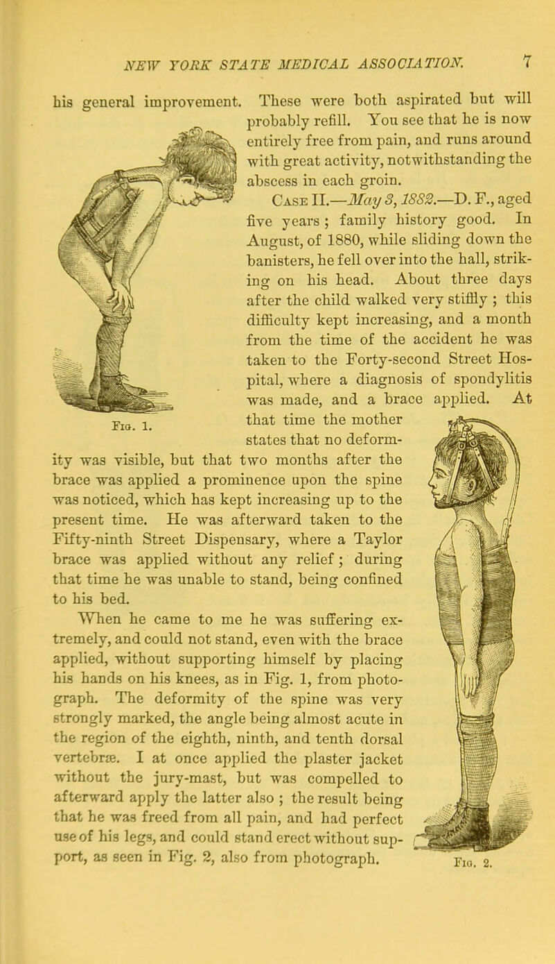 Yia. 1. his general improvement. These were both aspirated but will probably refill. You see that he is now entirely free from pain, and runs around with great activity, notwithstanding the abscess in each groin. Case II—May S, 18S2.—D. F., aged five years ; family history good. In August, of 1880, while sliding down the banisters, he fell over into the hall, strik- ing on his head. About three days after the child walked very stifliy ; this difiiculty kept increasing, and a month from the time of the accident he was taken to the Forty-second Street Hos- pital, where a diagnosis of spondylitis was made, and a brace applied. At that time the mother states that no deform- ity was visible, but that two months after the brace was applied a prominence upon the spine was noticed, which has kept increasing up to the present time. He was afterward taken to the Fifty-ninth Street Dispensary, where a Taylor brace was applied without any relief; during that time he was unable to stand, being confined to his bed. When he came to me he was suffering ex- tremely, and could not stand, even with the brace applied, without supporting himself by placing his hands on his knees, as in Fig. 1, from photo- graph. The deformity of the spine was very strongly marked, the angle being almost acute in the region of the eighth, ninth, and tenth dorsal vertebrte. I at once applied the plaster jacket without the jury-mast, but was compelled to afterward apply the latter also ; the result being that he was freed from all pain, and had perfect use of his legs, and could stand erect without sup- port, as seen in Fig. 2, also from photograph. yio. 2.