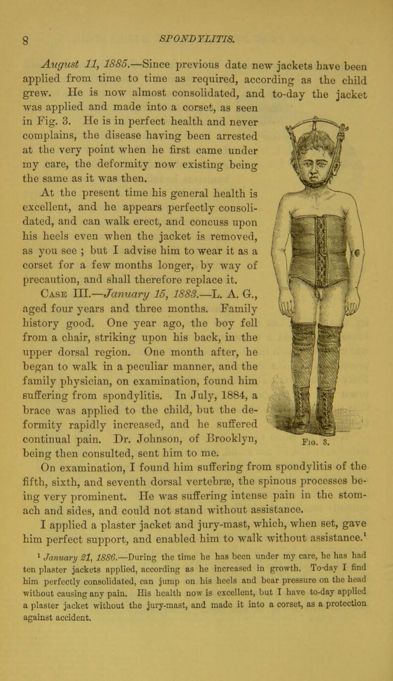 August 11, 1885.—Since previous date new jackets have been applied from time to time as required, according as the child grew. He is now almost consolidated, and to-day the jacket was applied and made into a corset, as seen in Fig. 3. He is in perfect health and never complains, the disease having been arrested at the very point when he first came under my care, the deformity now existing being the same as it was then. At the present time his general health is excellent, and he appears perfectly consoli- dated, and can walk erect, and concuss upon his heels even when the jacket is removed, as you see ; but I advise him to wear it as a corset for a few months longer, by way of precaution, and shall therefore replace it. Case HI.—January 15, 1883.—L. A. G,, aged four years and three months. Family history good. One year ago, the boy fell from a chair, striking upon his back, in the upper dorsal region. One month after, he began to walk in a peculiar manner, and the family physician, on examination, found him suffering from spondylitis. In July, 1884, a brace was applied to the child, but the de- formity rapidly increased, and he suffered continual pain. Dr. Johnson, of Brooklyn, being then consulted, sent him to me. On examination, I found him suffering from spondylitis of the fifth, sixth, and seventh dorsal vertebrre, the spinous processes be- ing very prominent. He was suffering intense pain in the stom- ach and sides, and could not stand without assistance. I applied a plaster jacket and jury-mast, which, when set, gave him perfect support, and enabled him to walk without assistance.' > January 21, ISSe—Drn'mg the time he has been under my care, he has had ten plaster jackets applied, according as he increased in growth. To-day I find him perfectly consolidated, can jump on his heels and bear pressure on the head without causing any pain. His health now is excellent, but I have to-day applied a plaster jacket without the jury-mast, and made it into a corset, as a protection against accident.