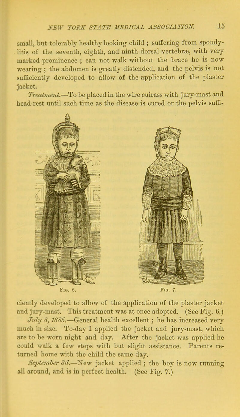 small, but tolerably liealthy looking child ; suffering from spondy- litis of the seventh, eighth, and ninth dorsal vertebra}, with very marked prominence ; can not walk without the brace he is now wearing ; the abdomen is greatly distended, and the pelvis is not sufficiently developed to allow of the application of the plaster jacket. Treatment.—To be placed in the wire cuirass with jury-mast and head-rest until such time as the disease is cured or the pelvis suffi- ciently developed to allow of the application of the plaster jacket and jury-mast. This treatment was at once adopted. (See Fig. 6.) July 3,1885.—General health excellent; he has increased very much in size. To-day I applied the jacket and jury-mast, which are to be worn night and day. After the jacket was applied he could walk a few steps with but slight assistance. Parents re- turned home with the child the same day. September Sd.—New jacket applied ; the boy is now running all around, and is in perfect health. (See Fig. 7.)