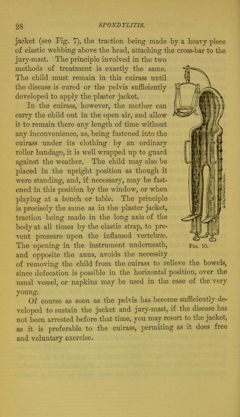 jacket (see Fig. 7), the traction being made by a heavy piece of elastic webbing above the head, attaching the cross-bar to the jury-mast. The principle involved in the two methods of treatment is exactly the same. The child must remain in this cuirass until the disease is cured or the pelvis sufficiently developed to apply the plaster jacket. In the cuirass, however, the mother can carry the child out in the open air, and allow it to remain there any length of time without any inconvenience, as, being fastened into the cuirass under its clothing by an ordinary roller bandage, it is well wrapped up to guard against the weather. The child may also be placed in the upright position as though it were standing, and, if necessary, may be fast- ened in this position by the window, or when playing at a bench or table. The principle is precisely the same as in the plaster jacket, traction being made in the long axis of the body at all times by the elastic strap, to pre- vent pressure upon the inflamed vertebras. The opening in the instrument underneath, and opposite the anus, avoids the necessity of removing the child from the cuirass to relieve the bowels, since defecation is possible in the horizontal position, over the usual vessel, or napkins may be used in the case of the very young. Of course as soon as the pelvis has become sufficiently de- veloped to sustain the jacket and jury-mast, if the disease has not been arrested before that time, you may resort to the jacket, as it is preferable to the cuirass, permiting as it does free and voluntary exercise. Fig. 10.