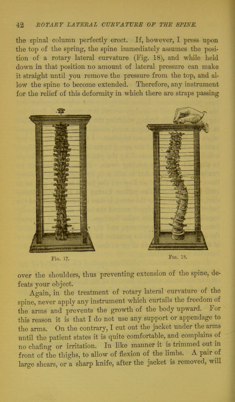 tlie spinal column perfectly erect. If, however, I press upon the top of the spring, the spine immediately assumes the posi- tion of a rotary lateral curvature (Fig. 18), and -wliile held down in that position no amount of lateral pressure can make it straight until you remove the pressure from the top, and al- low the spine to become extended. Therefore, any instrument for the relief of this deformity in which there are straps passing FiG. 17. 18. over the shoulders, thus preventing extension of the spine, de- feats your object. Again, in the treatment of rotary lateral curvature of the spine, never apply any instrument which curtails the freedom of the arms and prevents the growth of the body upward. For this reason it is that I do not use any support or appendage to the arms. On the contrary, I cut out the jacket under the arms until the patient states it is quite comfortable, and complains of no chafing or irritation. In like manner it is trimmed out in front of the thighs, to allow of flexion of the limbs. A pair of large shears, or a sharp knife, after the jacket is removed, will