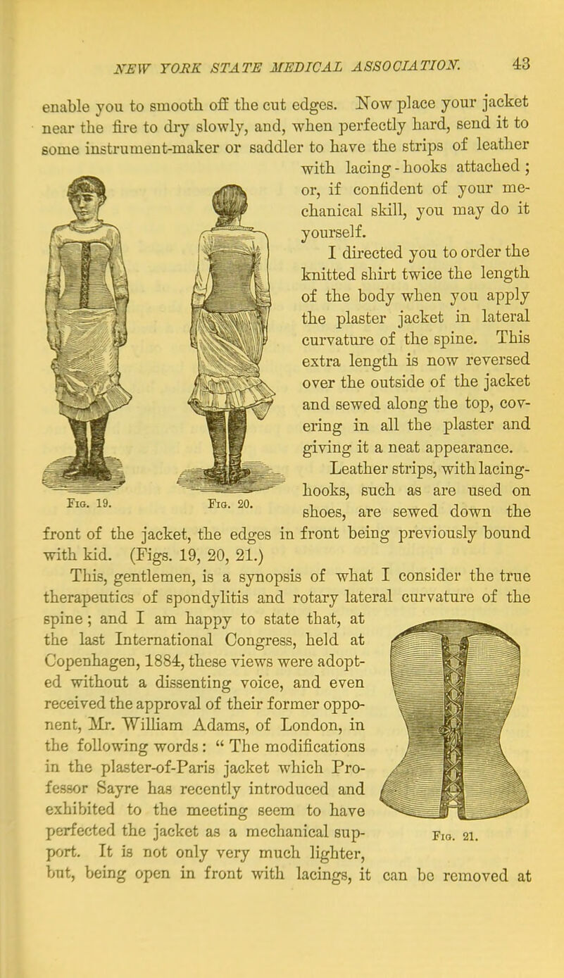 enable you to smooth off the cut edges. Now place your jacket near the tu-e to dry slowly, and, when perfectly hard, send it to some instrument-maker or saddler to have the strips of leather with lacing - hooks attached ; or, if confident of your me- chanical skill, you may do it yourself. I directed you to order the knitted shirt twice the length of the body when you apply the plaster jacket in lateral curvature of the spine. This extra length is now reversed over the outside of the jacket and sewed along the top, cov- ering in all the plaster and giving it a neat appearance. Leather strips, with lacing- hooks, such as are used on shoes, are sewed down the front of the jacket, the edges in front being previously bound with kid. (Figs. 19, 20, 21.) This, gentlemen, is a synopsis of what I consider the true therapeutics of spondylitis and rotary lateral curvature of the spine; and I am happy to state that, at the last International Congress, held at Copenhagen, 1884, these views were adopt- ed without a dissenting voice, and even received the approval of their former oppo- nent, ;Mr. William Adams, of London, in the following words:  The modifications in the plaster-of-Paris jacket which Pro- fessor Sayre has recently introduced and exhibited to the meeting seem to have perfected the jacket as a mechanical sup- port. It is not only very much lighter, but, being open in front with lacings, it can be removed at Fio. 19. Fio. 20. Fio. 21.