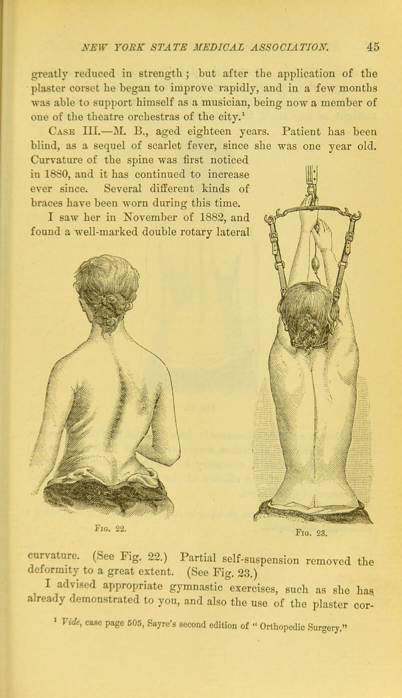 greatly reduced in strength ; but after the application of the plaster corset he hegan to improve vapidly, and in a few months was able to support himself as a musician, being now a member of one of the theatre orchestras of the city.* Case III.—M. B., aged eighteen years. Patient has been blind, as a sequel of scarlet fever, since she was one year old. Curvature of the spine was first noticed in 1880, and it has continued to increase ever since. Several different kinds of braces have been worn during this time. I saw her in November of 1882, and found a well-marked double rotary lateral Fio. 22. Fio. 23. curvature. (See Fig. 22.) Partial self-suspension removed the deformity to a great extent. (See Fig. 23.) I advised appropriate gymnastic exercises, such as she has. already demonstrated to you, and also the use of the plaster cor- ' Vide, case page 505, .Sayrc's second edition of  Orthopedic Surgery.