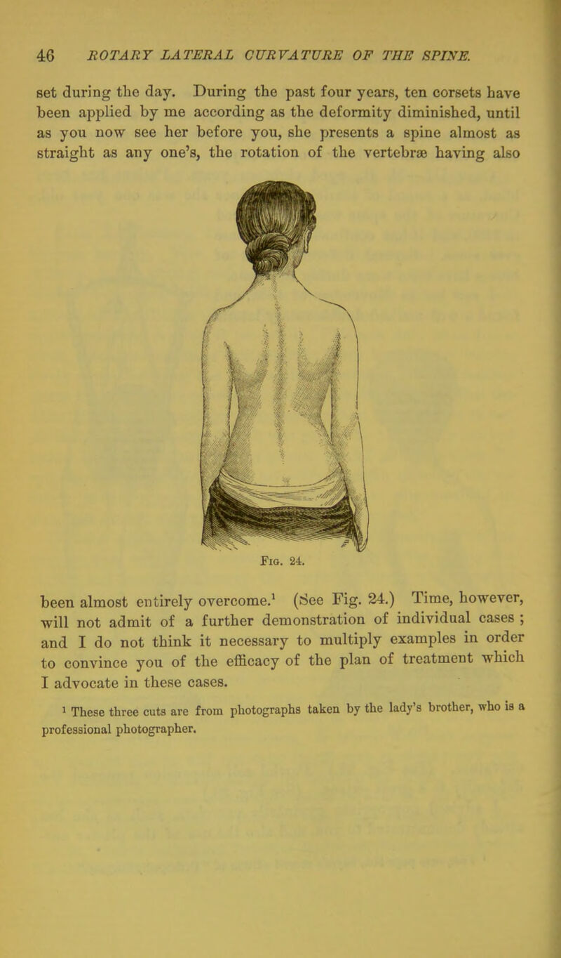 set during the day. During the past four years, ten corsets have been applied by me according as the deformity diminished, until as you now see her before you, she presents a spine almost as straight as any one's, the rotation of the vertebriB having also Fio. 24. been almost entirely overcome.' (See Fig. 24.) Time, however, will not admit of a further demonstration of individual cases ; and I do not think it necessary to multiply examples in order to convince you of the efficacy of the plan of treatment which I advocate in these cases. 1 These three cuts are from photographs taken by the lady's brother, who is a professional photographer.