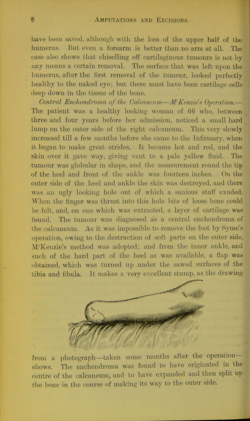 have been saved, altliou^'li with the loss of the upper half of tlje humerus. But even a forearm is better than no arm at all. The case also shows that chiselling off cartilaginous tumours is not by any means a certain removal. The surface that was left upon the liumerus, after the first removal of the tumour, looked perfectly liealthy to the naked eye; but there nmst have been cartilage cells deep down in the tissue of the bone. Central Enchondrmna of the Galcanrum—M'Kcnzies (}perat'um.— The patient was a healthy looking woman of 66 who, between three and four years before her admission, noticed a small hard lump on the outer side of the right calcaneum. This very slowly increased till a few months before she came to the Infirmary, when it began to make great strides. Jt became hot and red, and the skin over it gave way, giving vent to a pale yellow Huid. The tumour was globular in shape, and the measurement round the tip of the heel and front of the ankle was fourteen inches. On the outer side of the heel and ankle the skin was destroyed, and there was an ugly looking hole out of which a sanious stuff exuded. When the finger was thrust into this hole bits of loose bone could be felt, and, on one which was extracted, a laj'er of cartilage was found. The tumour was diagnosed as a central enchondroma of the calcaneum. As it was impossible to remove the foot by Syme's operation, owing to the destruction of soft parts on the outer side, M'Kenzie's method was adopted; and from the inner ankle, and such of the hard part of the heel as was available, a flap was obtained, which was turned up under the sawed surfaces of the tibia and fibula. Tt makes a very excellent stump, as the drawing from a photograph—taken some months after the operation- shows. The enchondroma was found to have originated in the centre of the calcaneum, and to have expanded and then split up the bone in the course of making its way to the outer side.